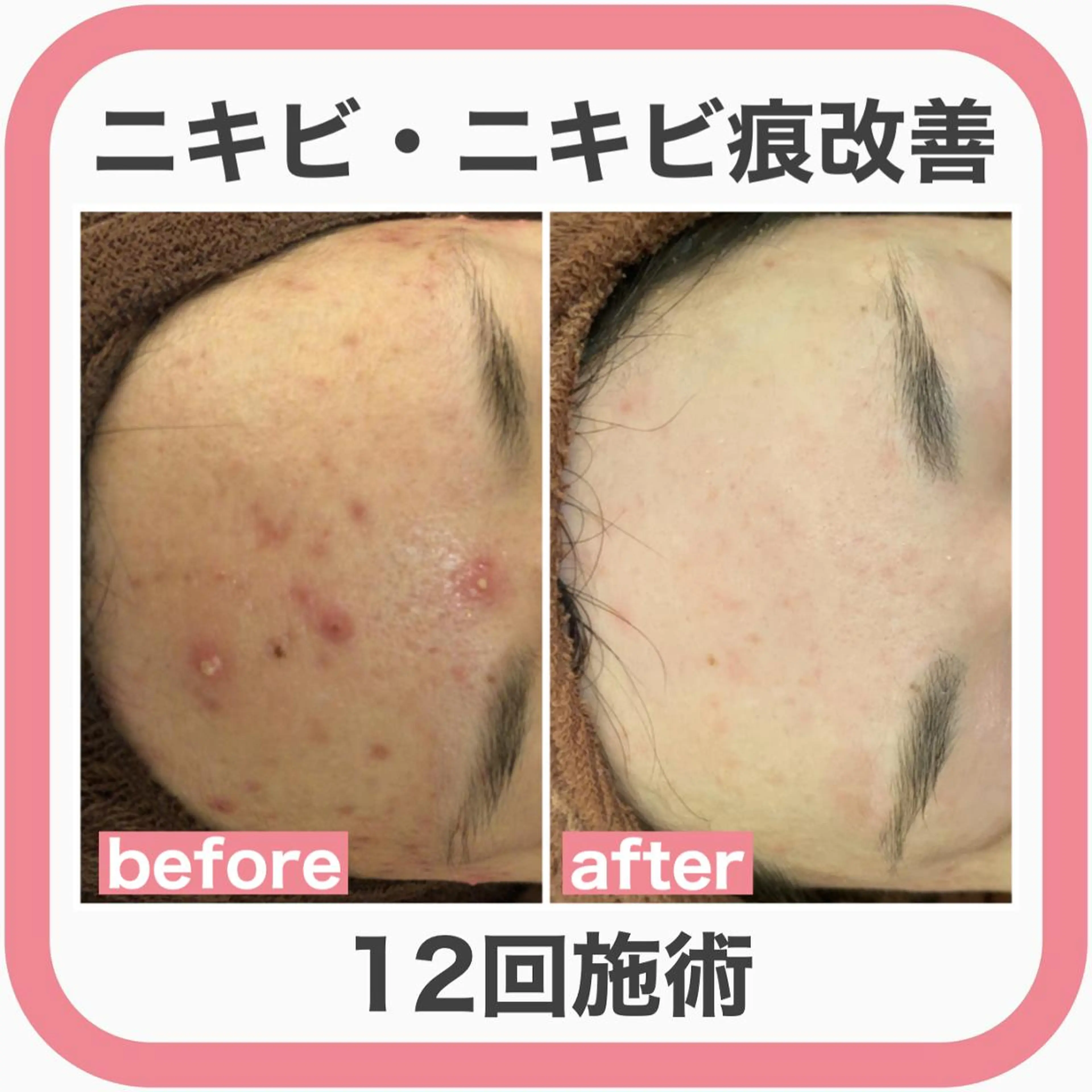 皮膚科より効果あり ⁉️最短ニキビ改善のエステ・リラクイメージ