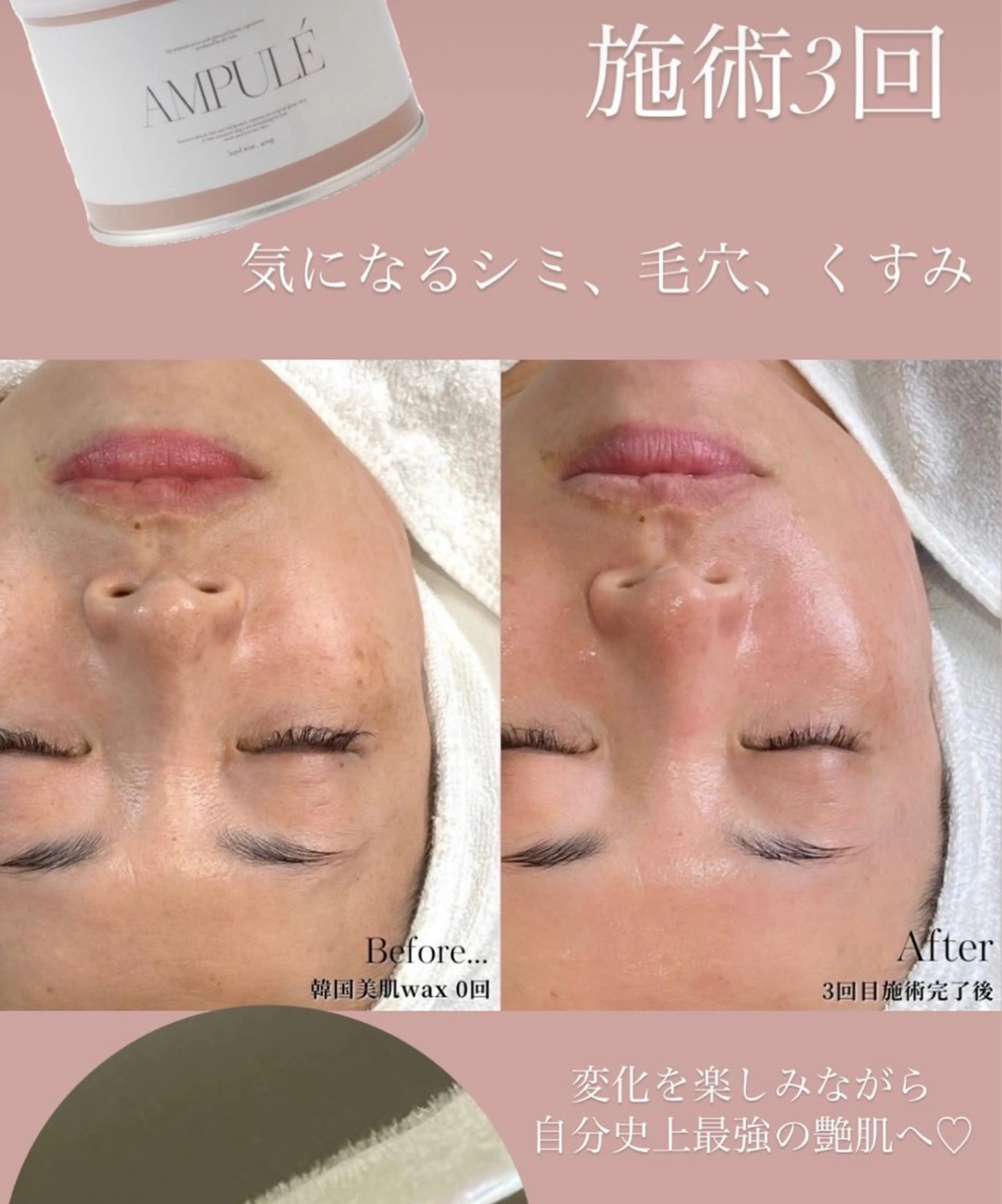 アイブロウ＋おでこ＋もみあげ脱毛＋小鼻の写真