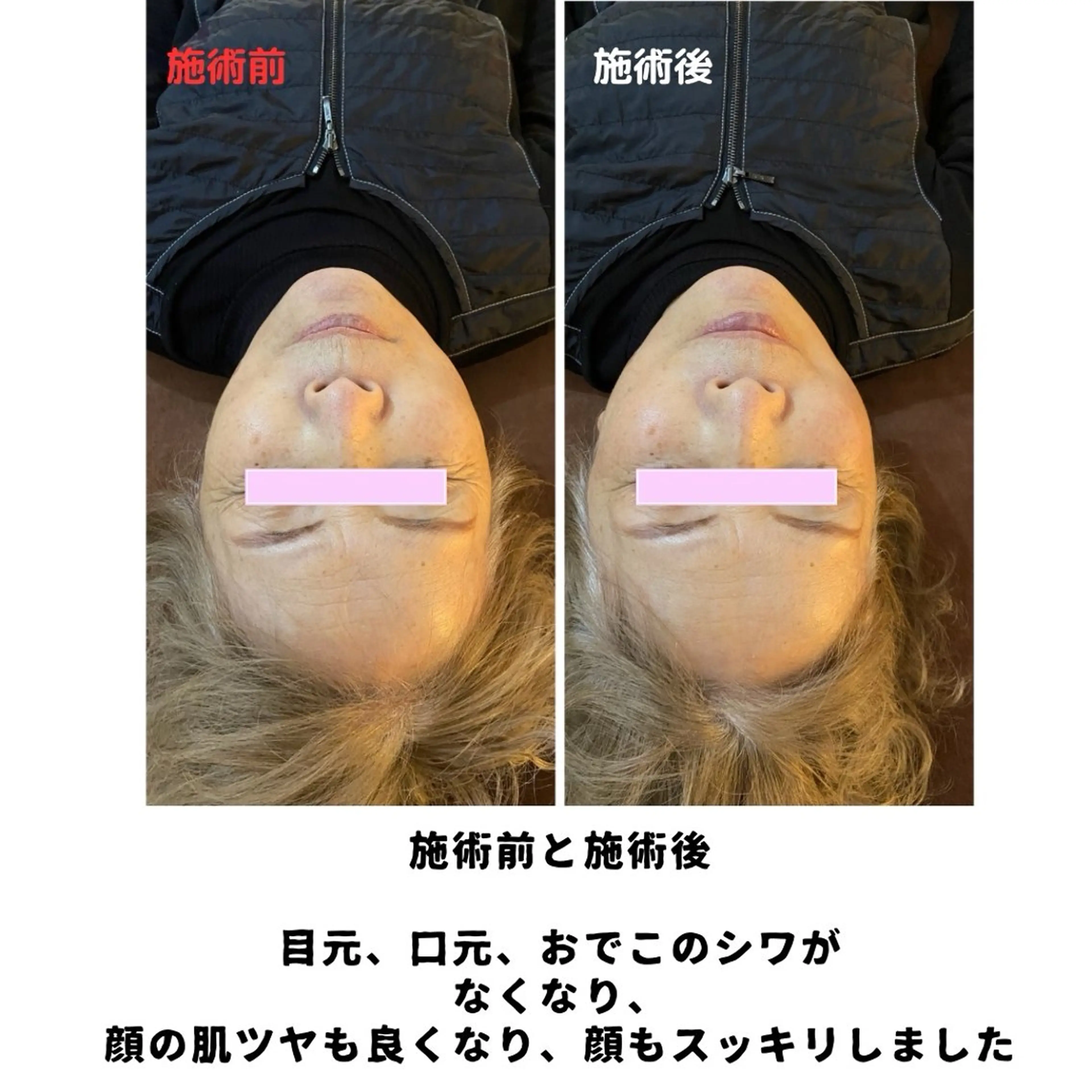 【大人気NO.2】筋膜アプローチ＋ドライヘッドスパ45分 95分の写真