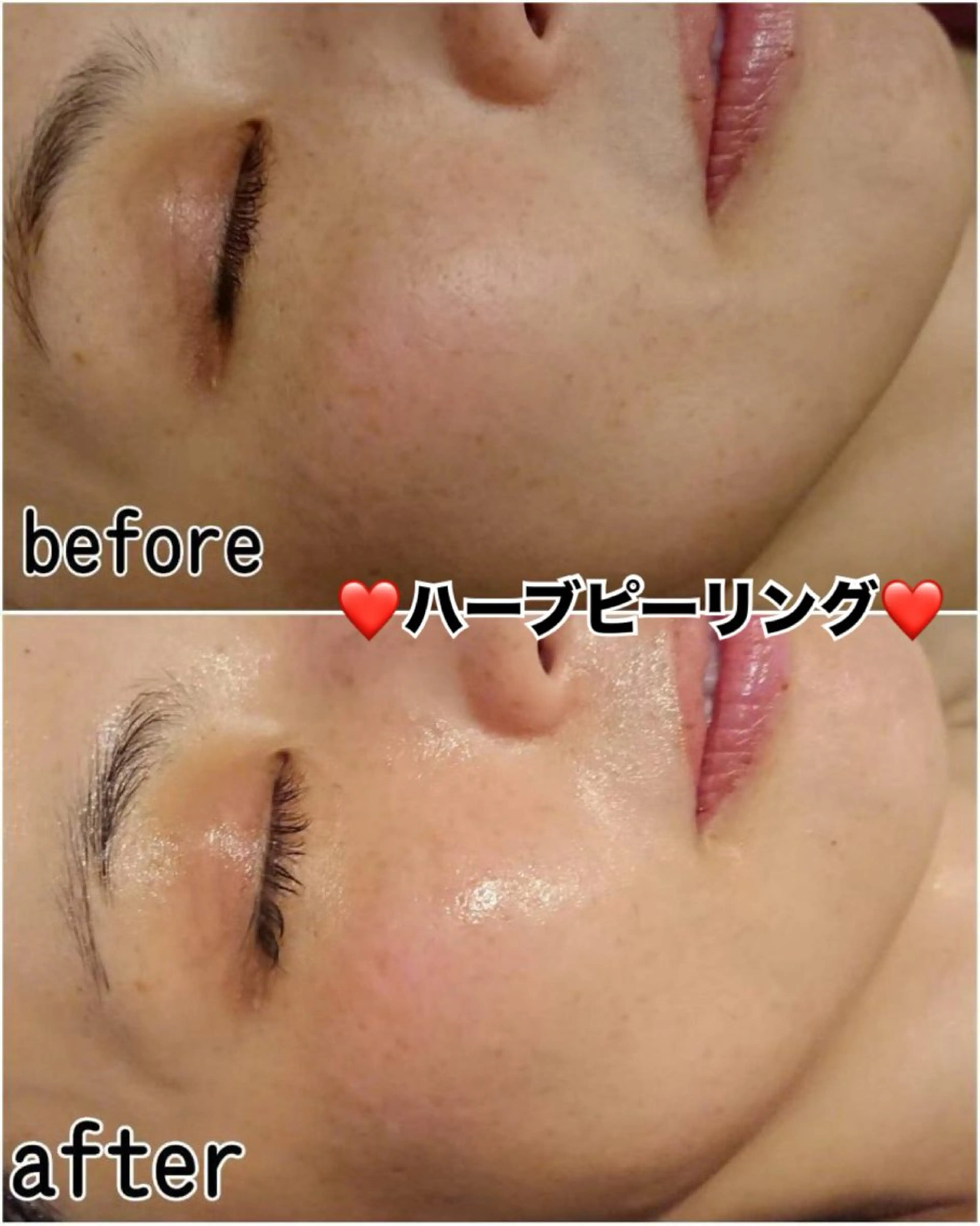 エステ ハーブピーリング/韓国肌管理/フェイシャル/毛穴洗浄/眉毛/顔脱毛【糸脱毛専門】rev所属・ハーブピーリング🌹 毛穴洗浄❤️眉waxのエステ・リラクイメージ