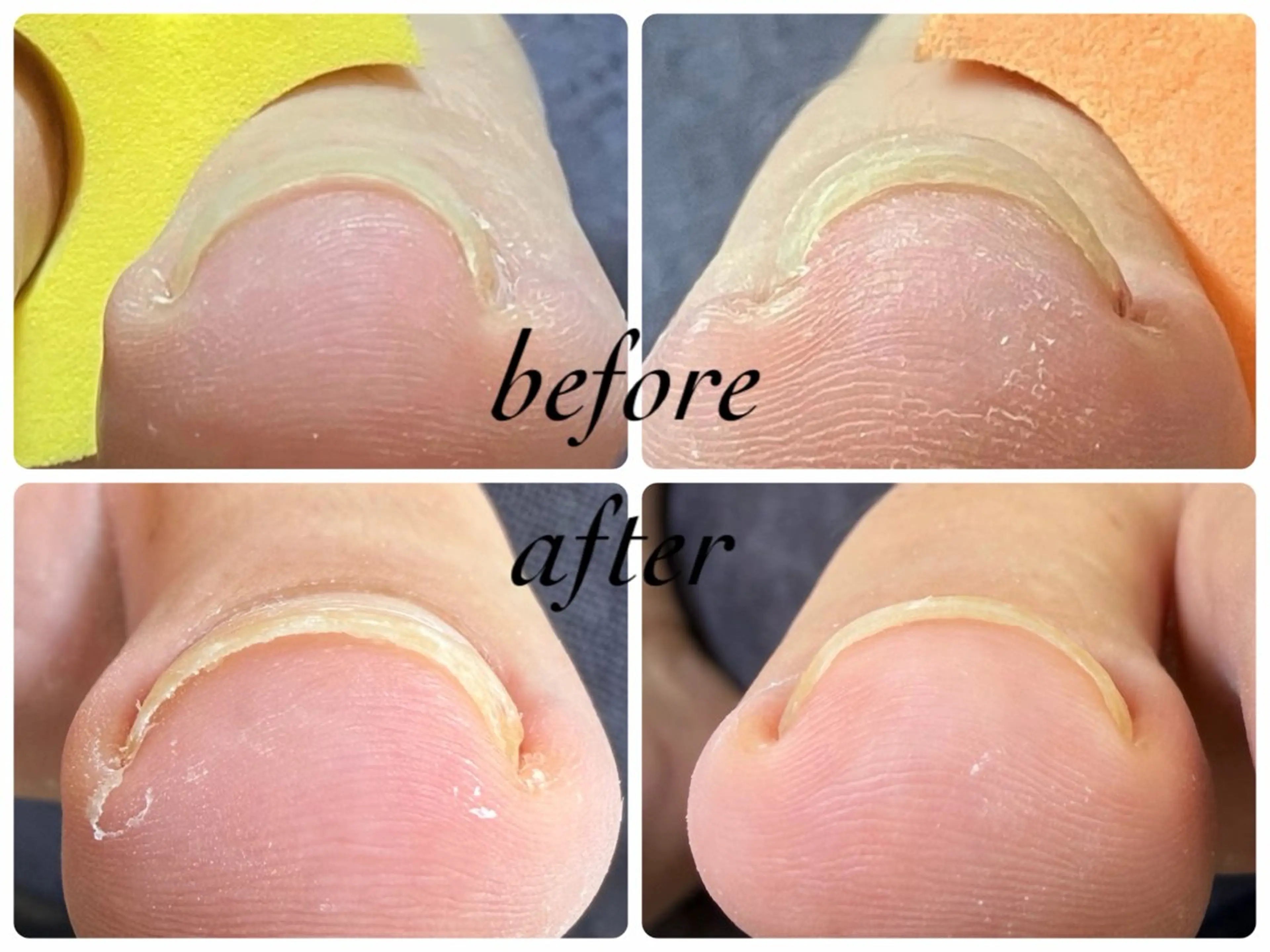 巻き爪ケアの写真