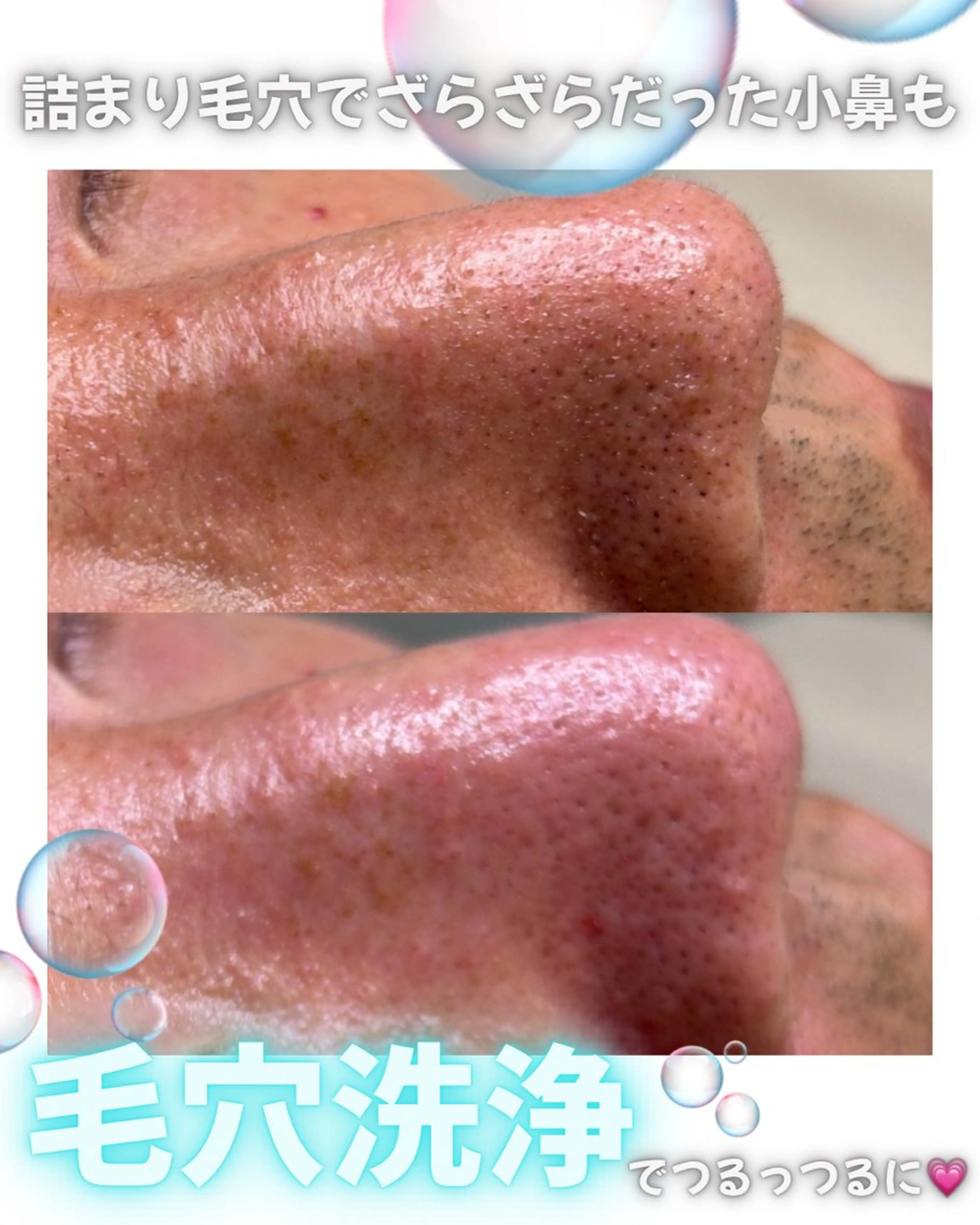 毛穴洗浄🫧 全顔の写真