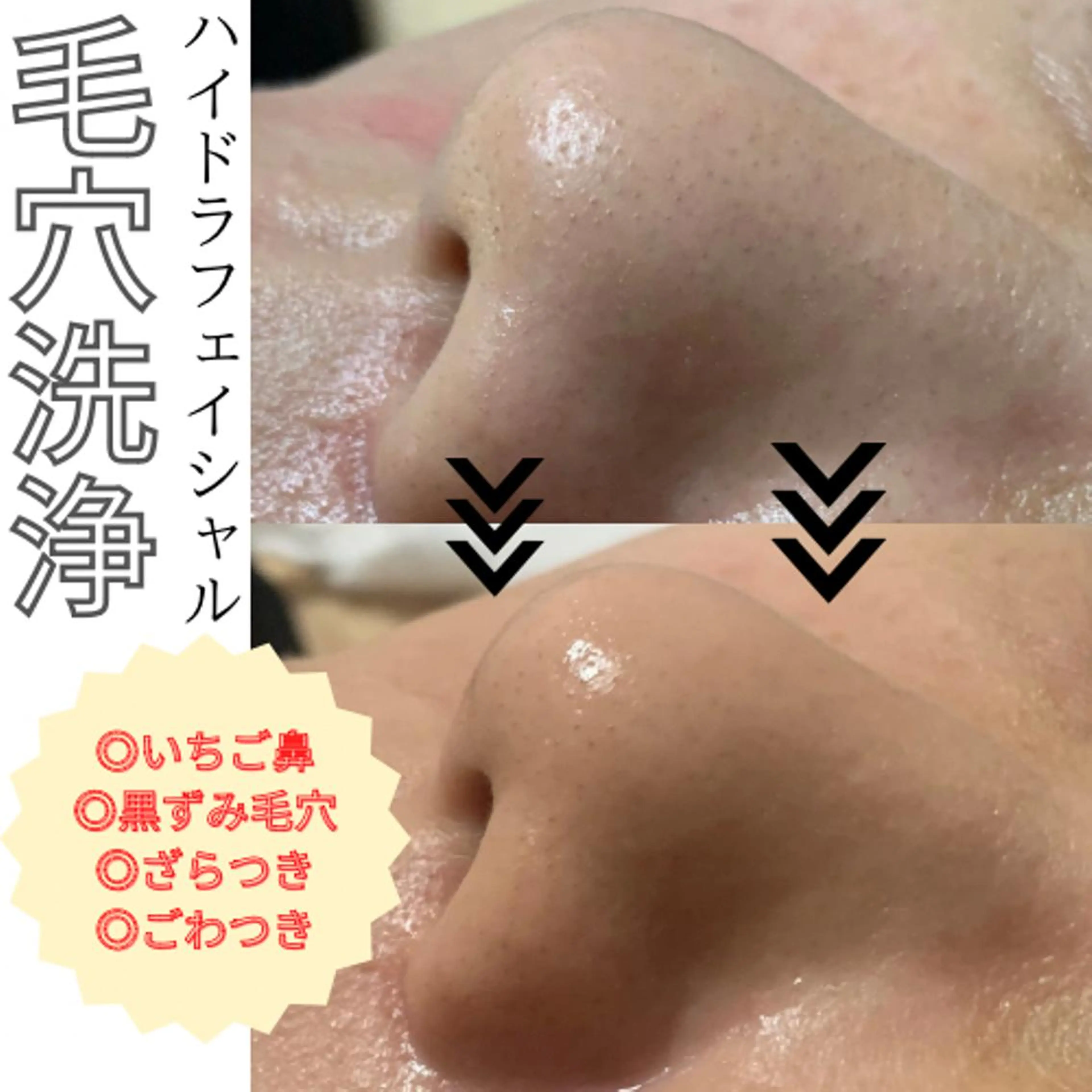 【部分】ハイドラフェイシャル✨Tゾーン、鼻、小鼻👃 黒ずみ/ざらつき/角栓の写真