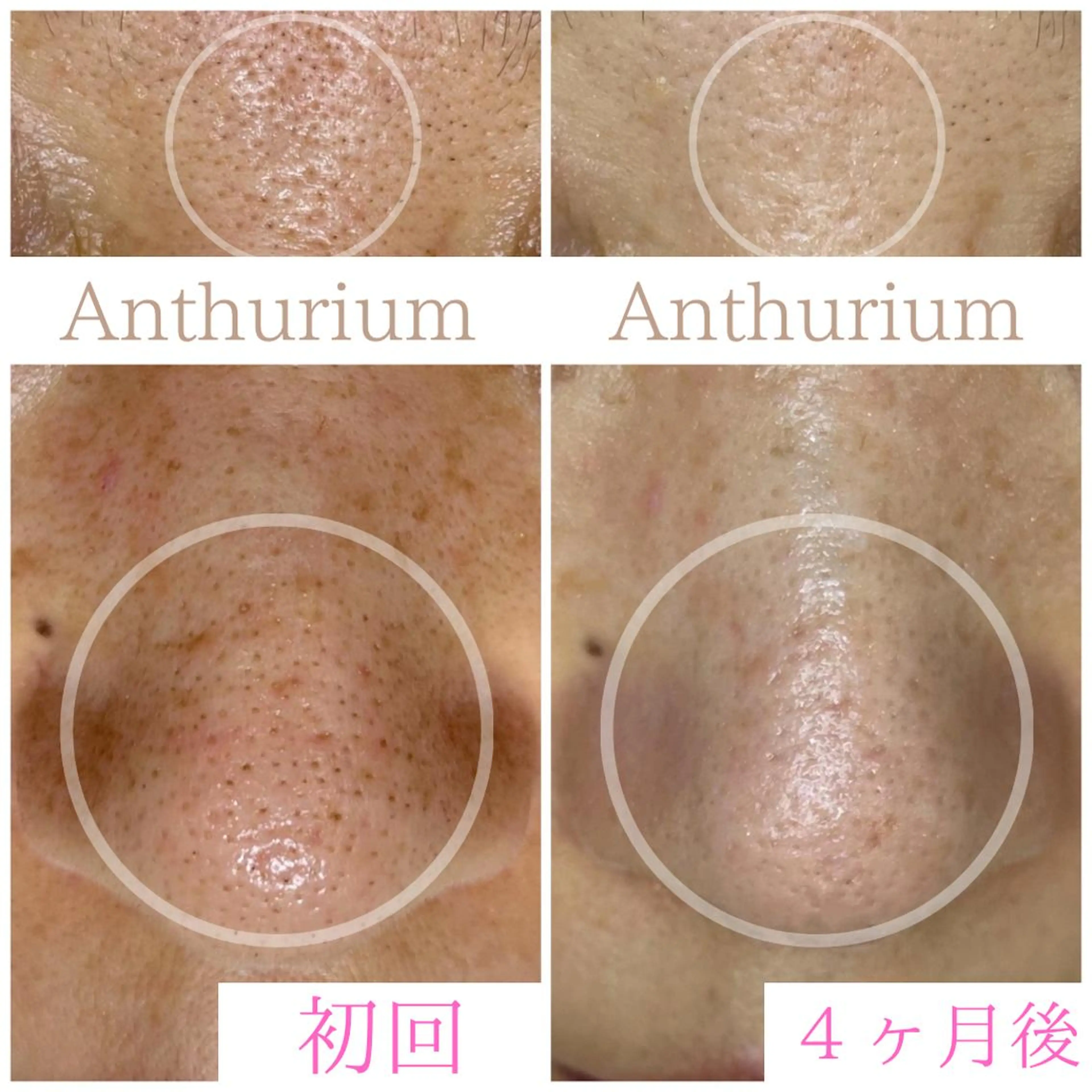 毛穴ケア専門サロンアンスリウム所属・茨城土浦 つくば毛穴 ケア専門サロンのエステ・リラクイメージ