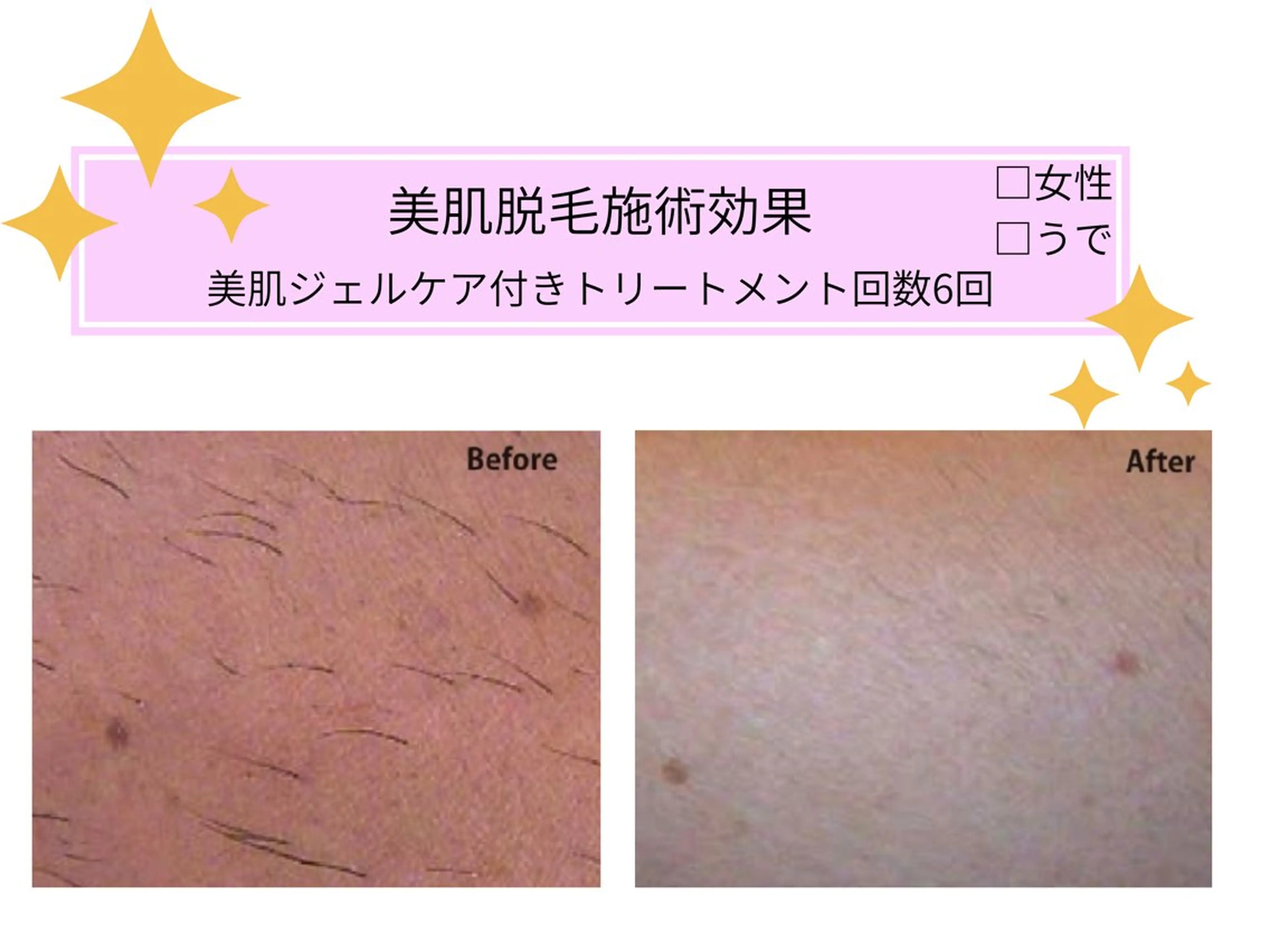 脱毛 VIKI BEAUTY  クレイハーブピーリング・美肌脱毛専門店所属・VIKI BEAUTYのエステ・リラクイメージ