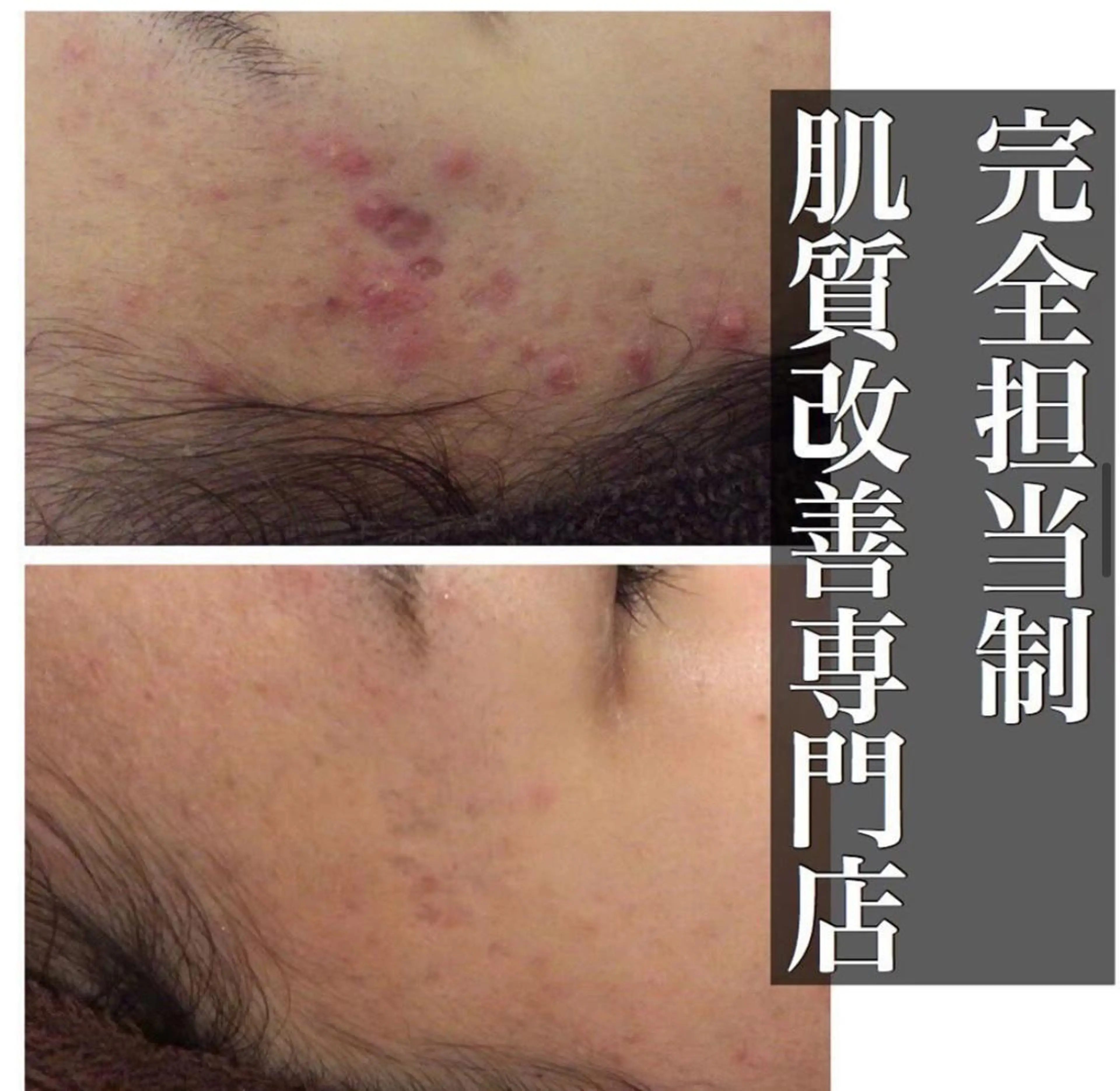 ショート メンズ キッズ マツエク・マツパ ネイル アイブロウ カラー パーマ ヘアアレンジ ニキビ跡改善専門🔥 医療にはできない改善のエステ・リラクイメージ