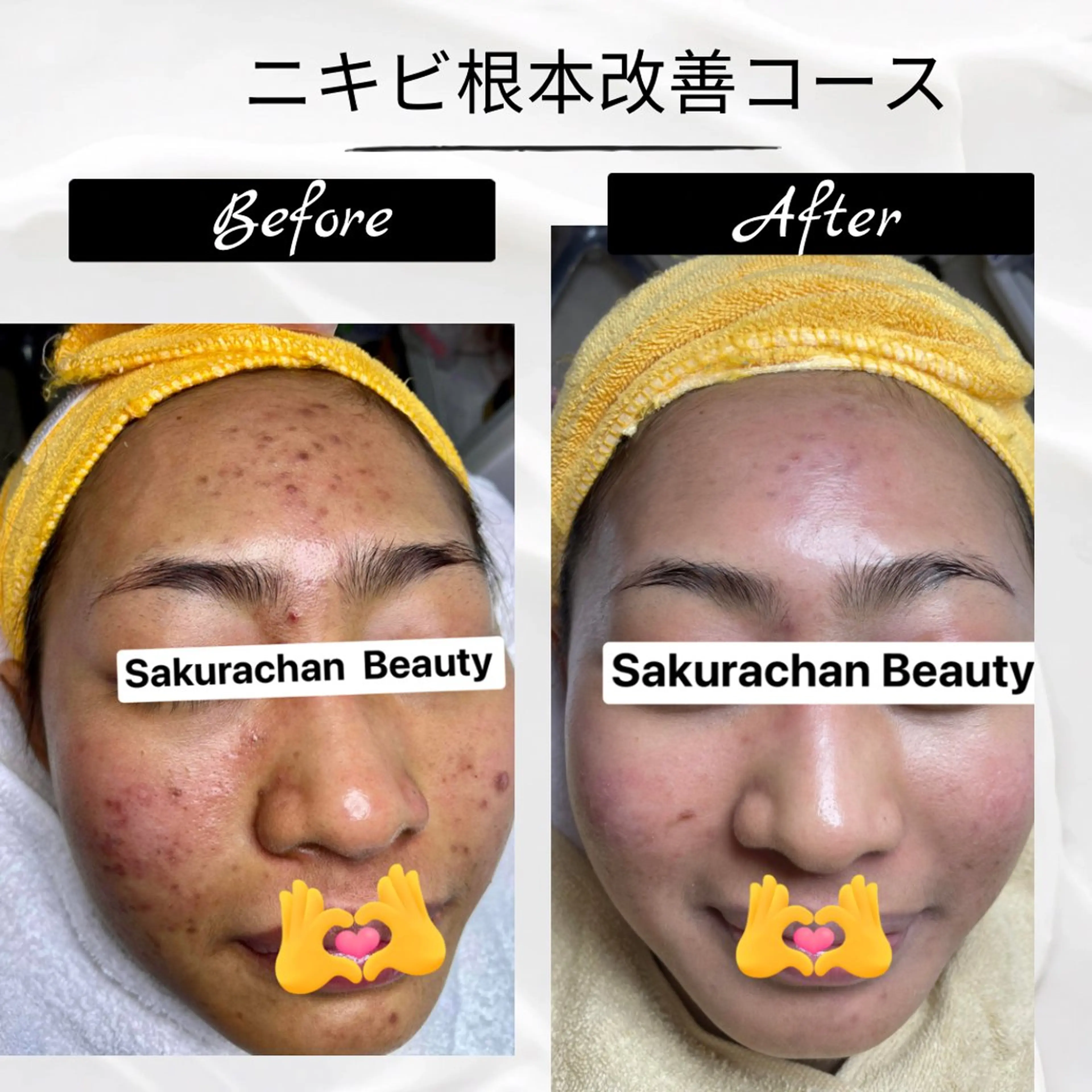 エステ ニキビ、痩身、脱毛、 サクラチャンスパのエステ・リラクイメージ