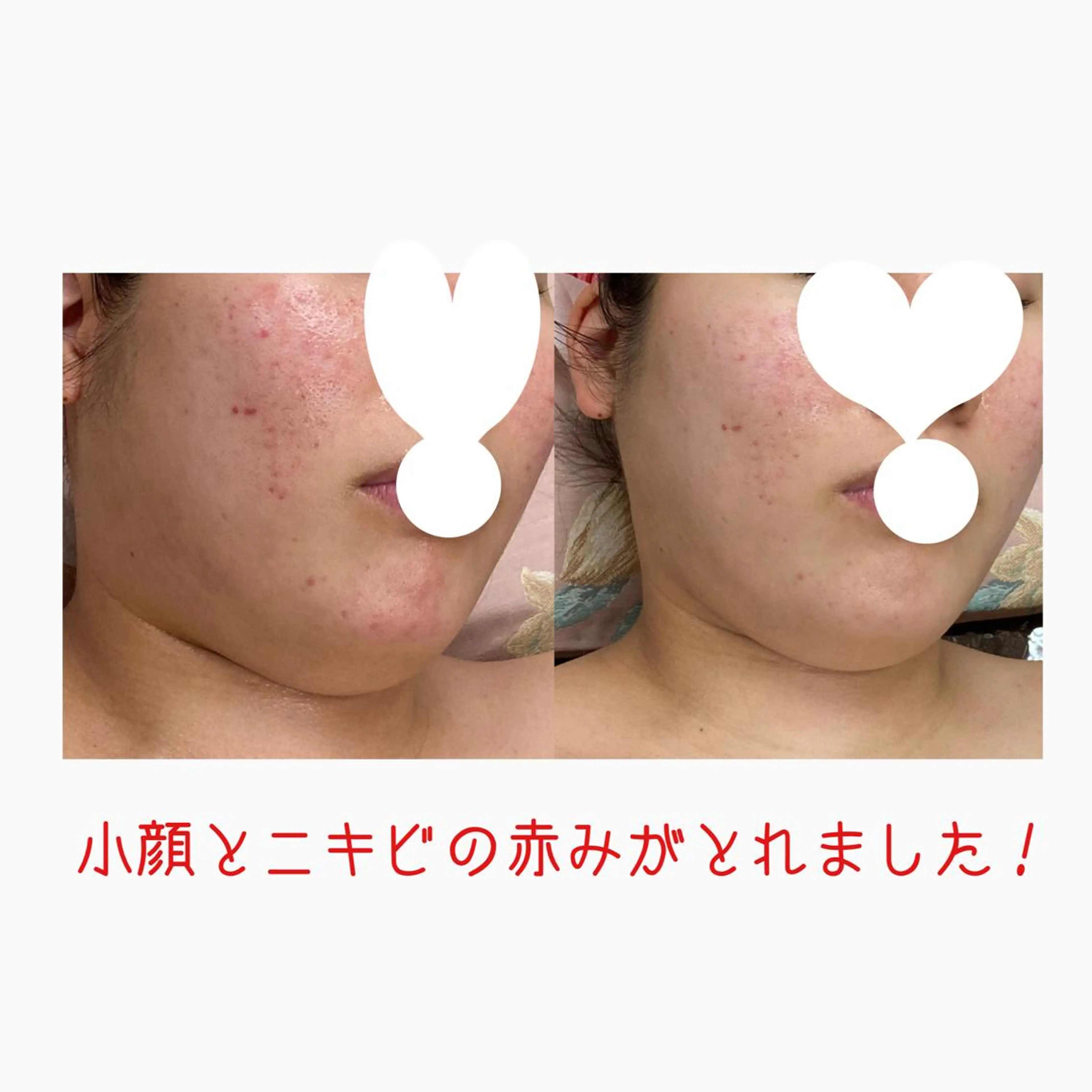 オアシス・さくら所属・中村貴子都度払い脱毛 小顔コルギのエステ・リラクイメージ