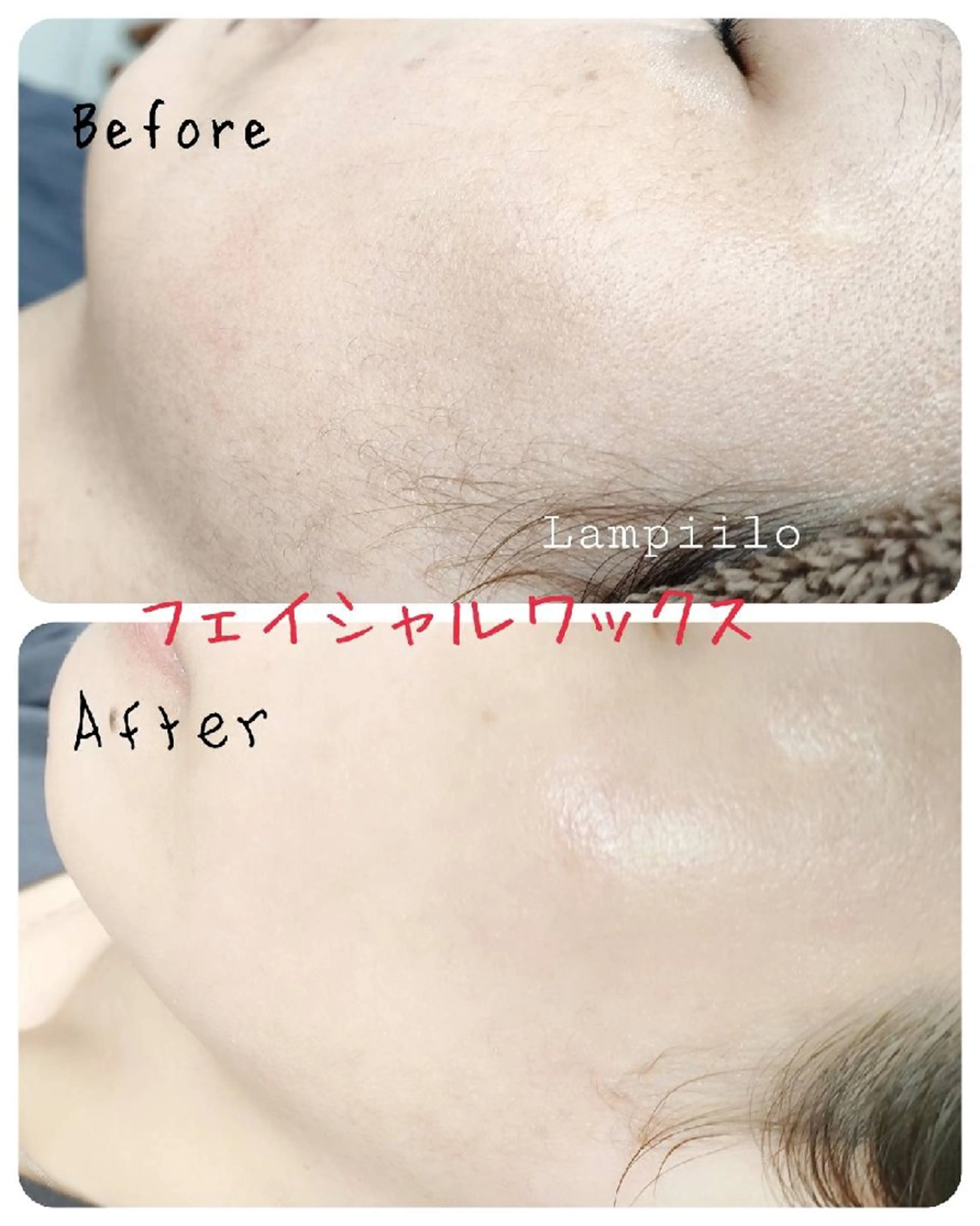 フェイシャルワックス(顔全体・パック付き)の写真