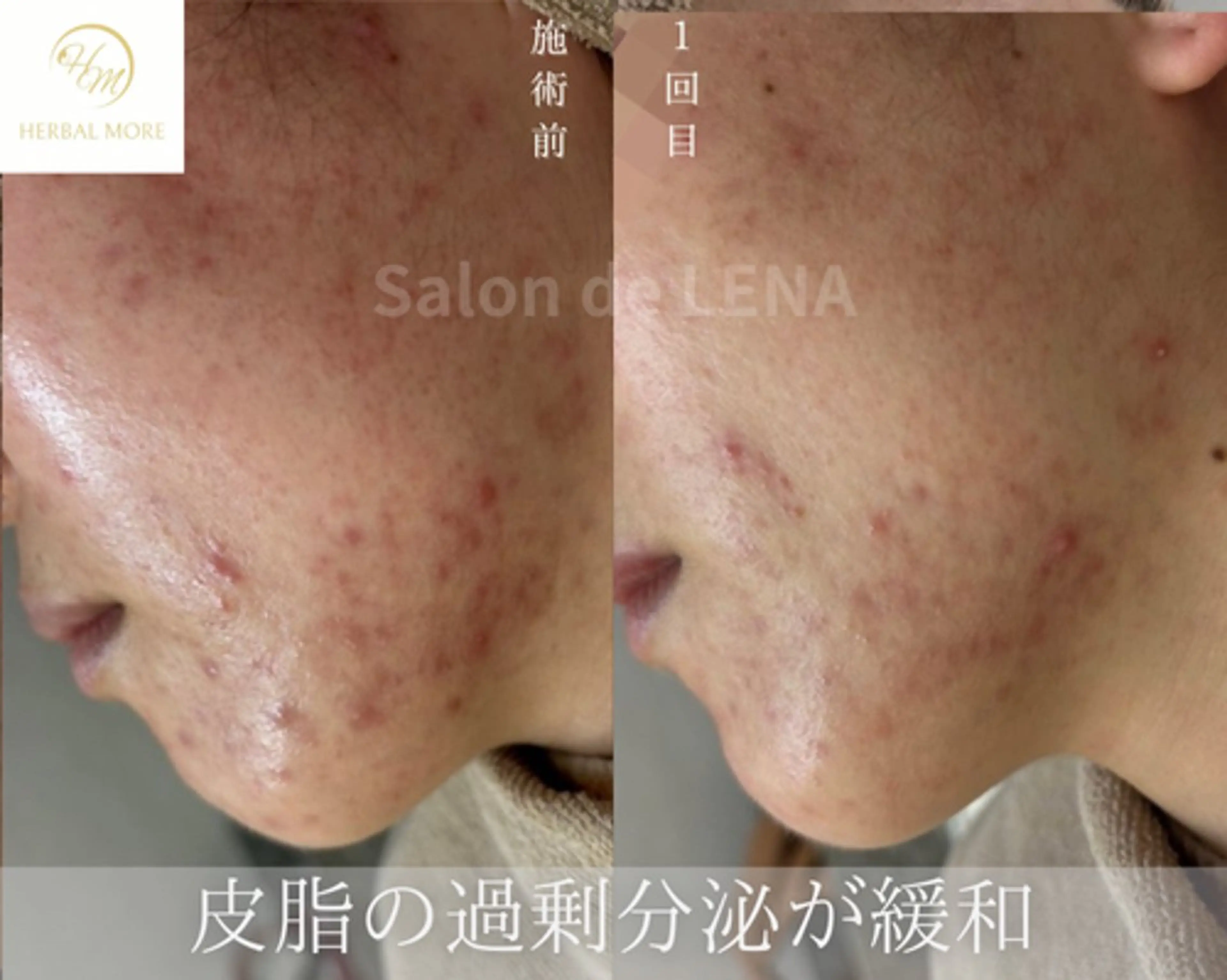 リラク サロンドレナ名駅店所属・ハーブピーリング専門 サロンドレナ平岡のエステ・リラクイメージ