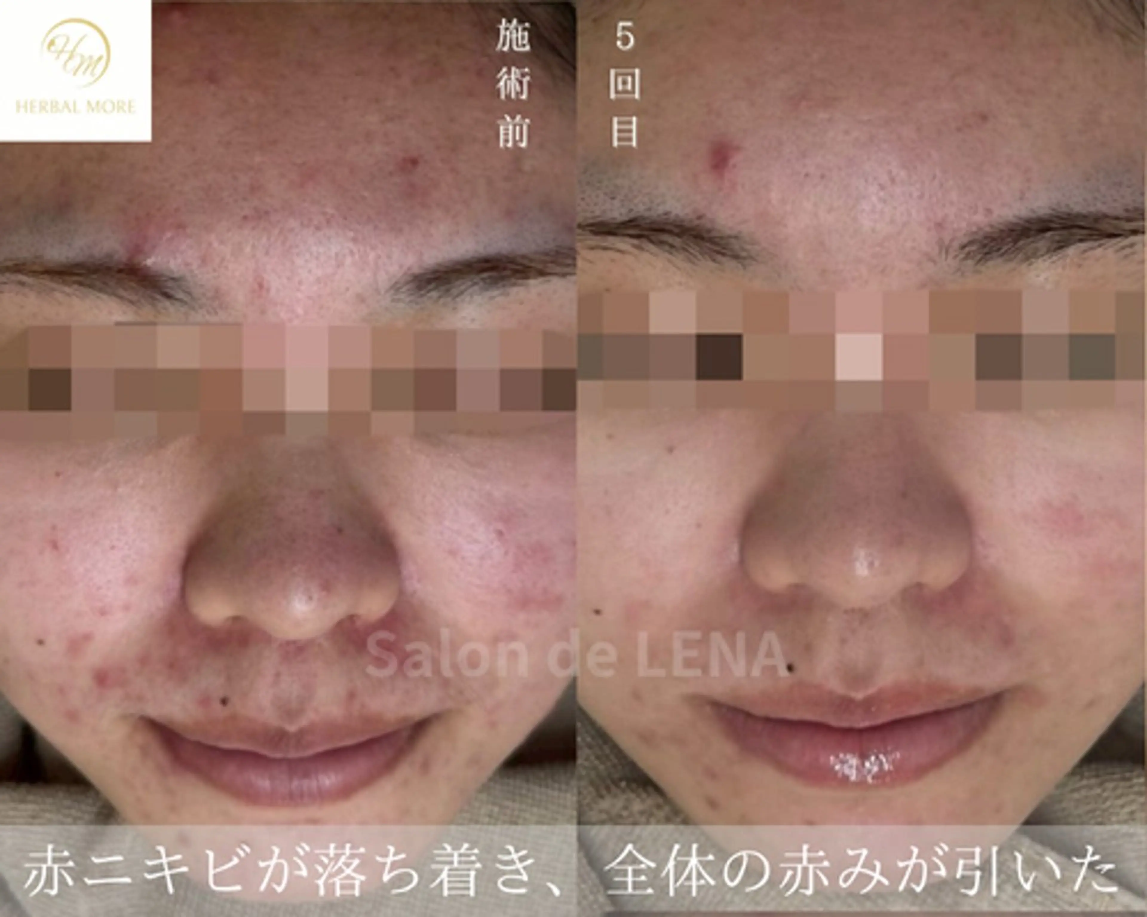 ハーブピーリング・毛穴ケア専門サロンSalon de LENA 栄店所属・ハーブピーリング専門 サロンドレナ　白藤のエステ・リラクイメージ