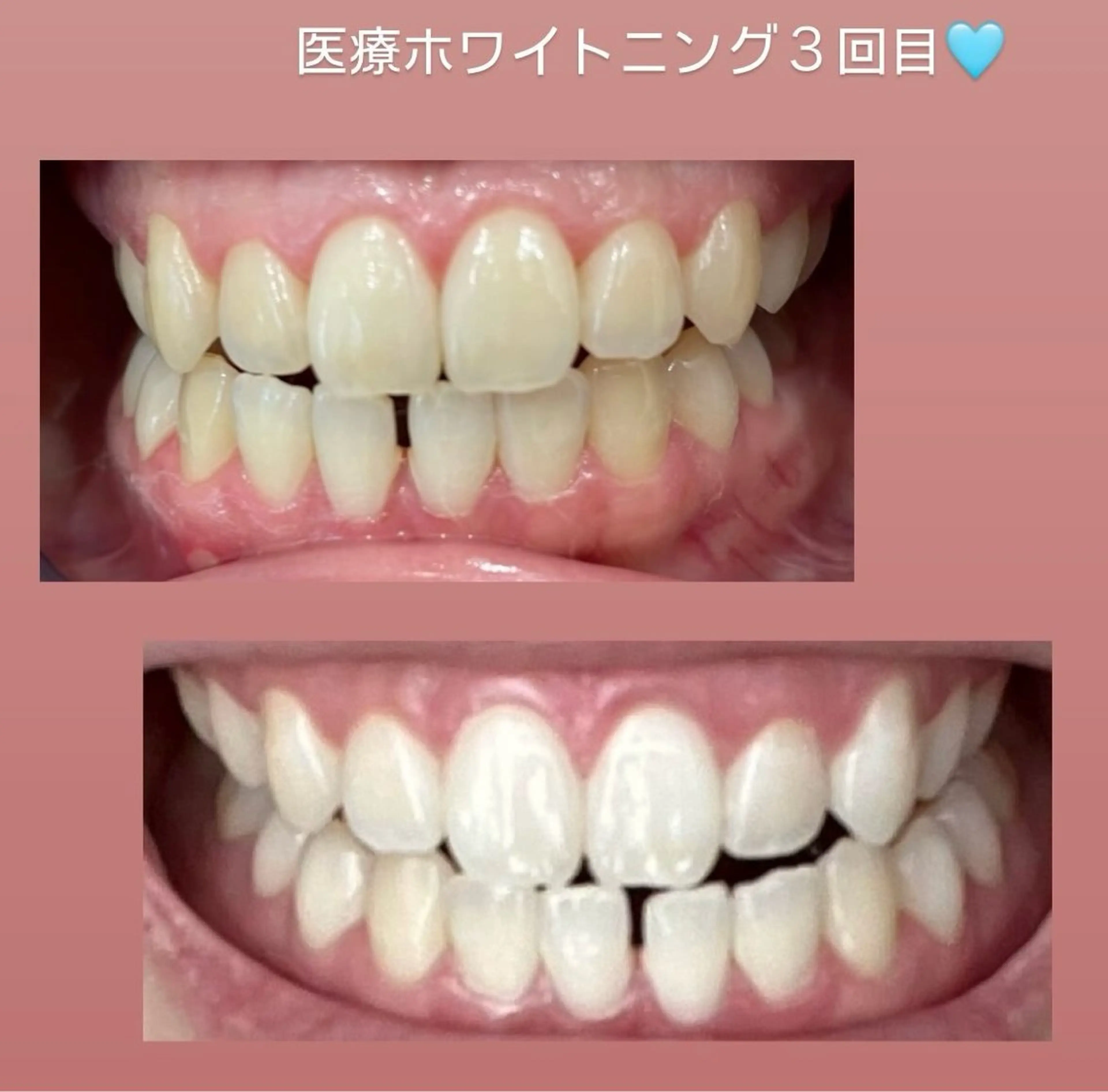 Kaula所属・Kaula セルフホワイトニングのその他イメージ