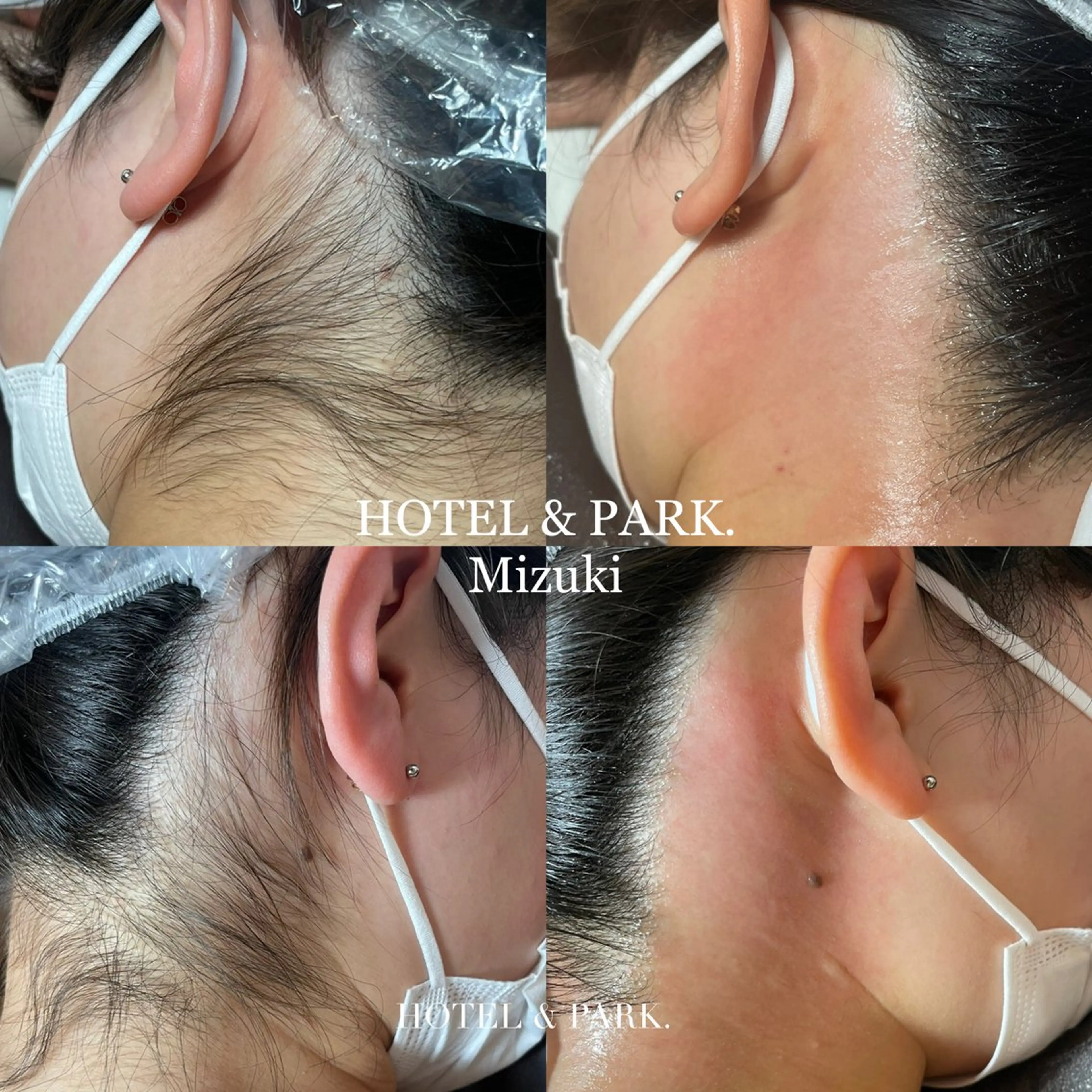 脱毛 HOTEL&PARK . ワックス脱毛のエステ・リラクイメージ