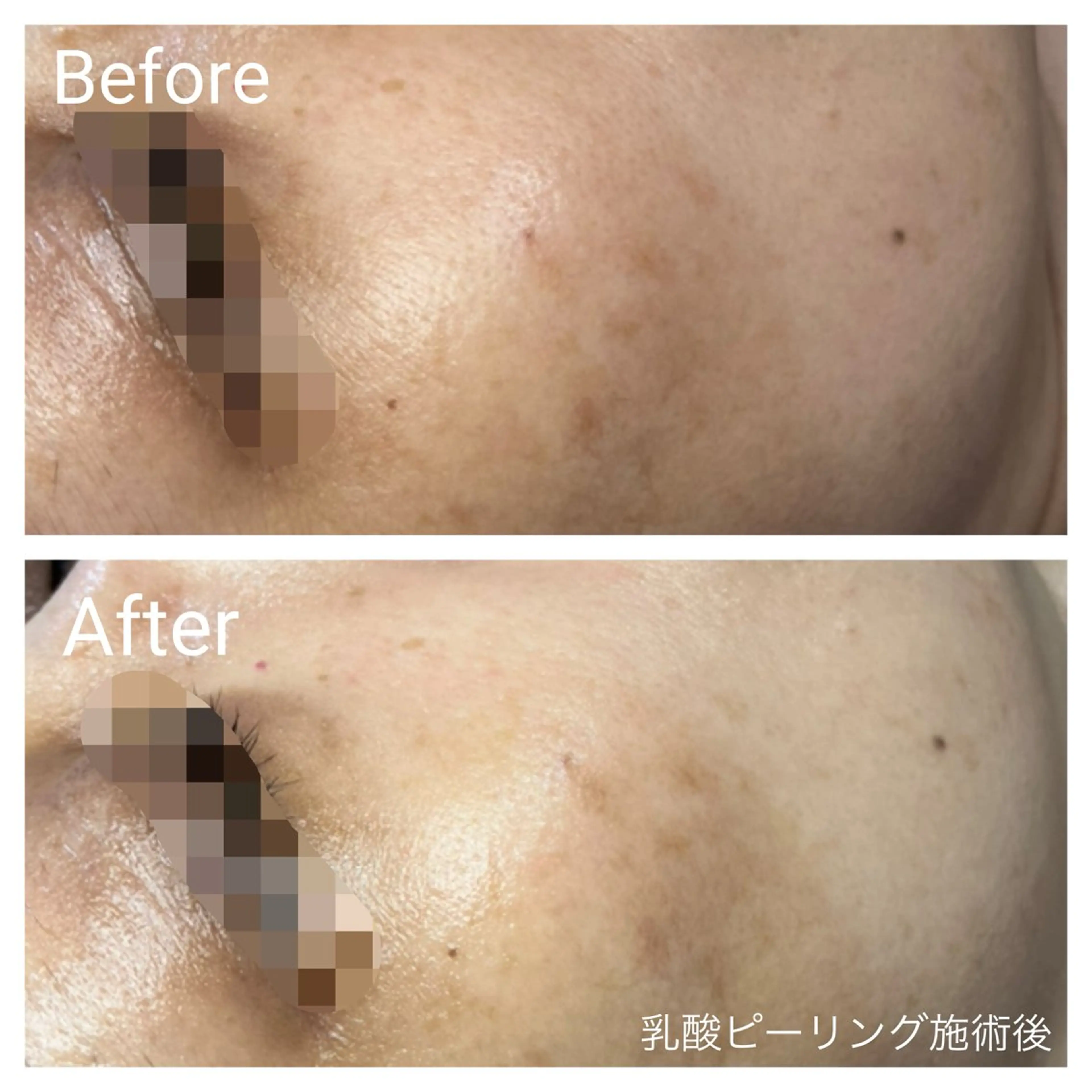 🌼夏にお勧め🌼【日焼けによるシミ、ニキビ跡、美白に】お肌に優しい低刺激乳酸ピーリングフェイシャル60分の写真