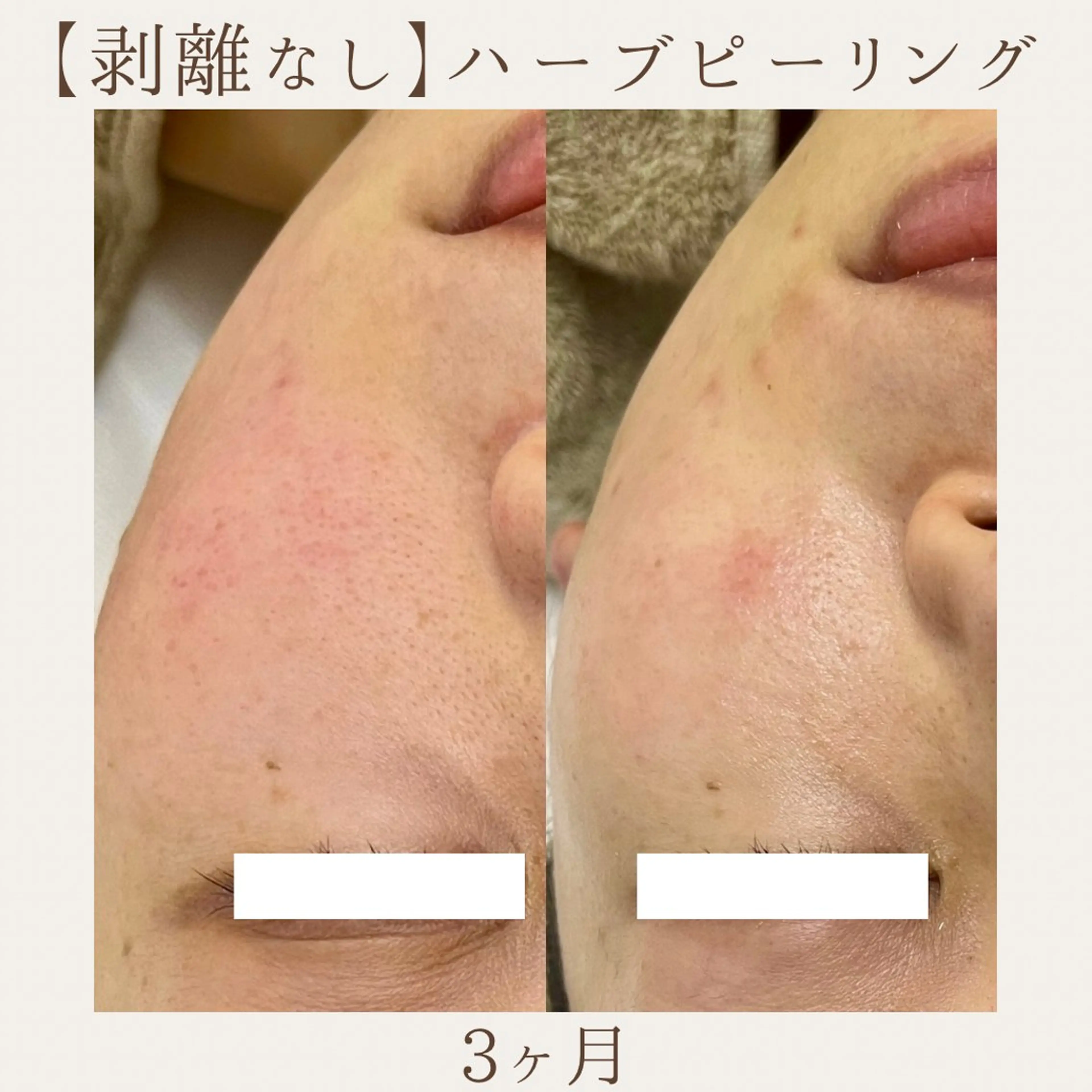 エステ 肌質改善サロン renew所属・肌質改善サロン renew/ｳｴｷのエステ・リラクイメージ