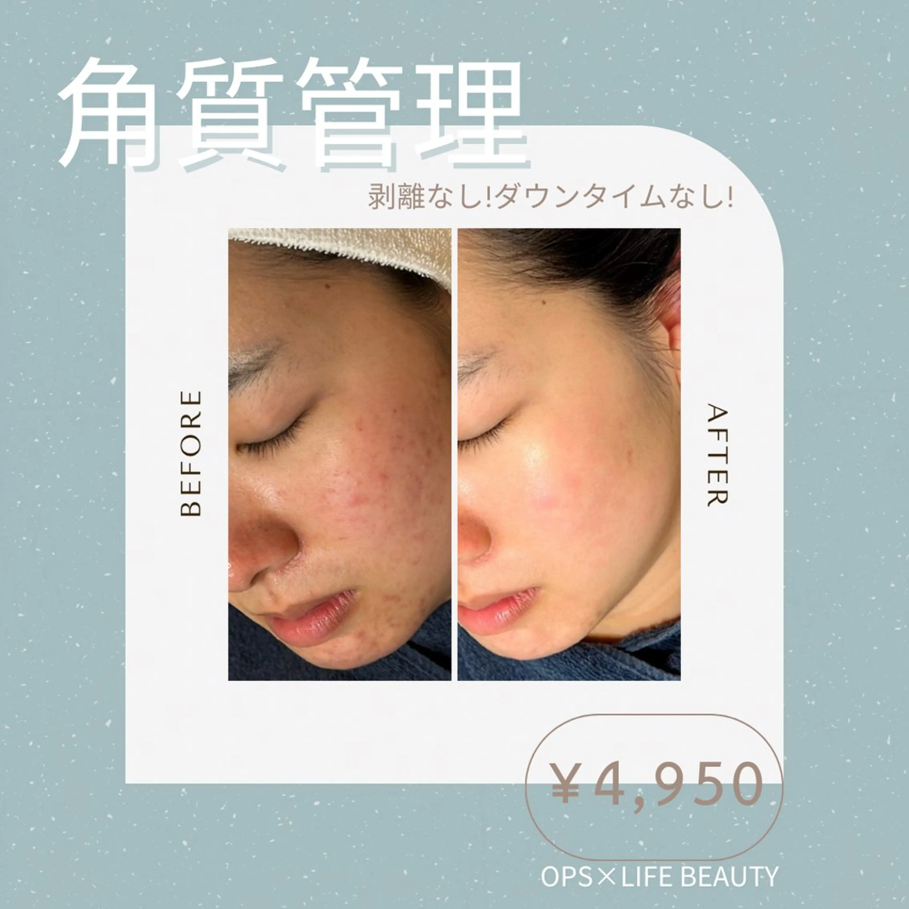 【韓国式角質管理】剥離なし！痛みなし！◇水光肌ラダメールピーリング＆水光肌セラム40分コース￥4,950の写真