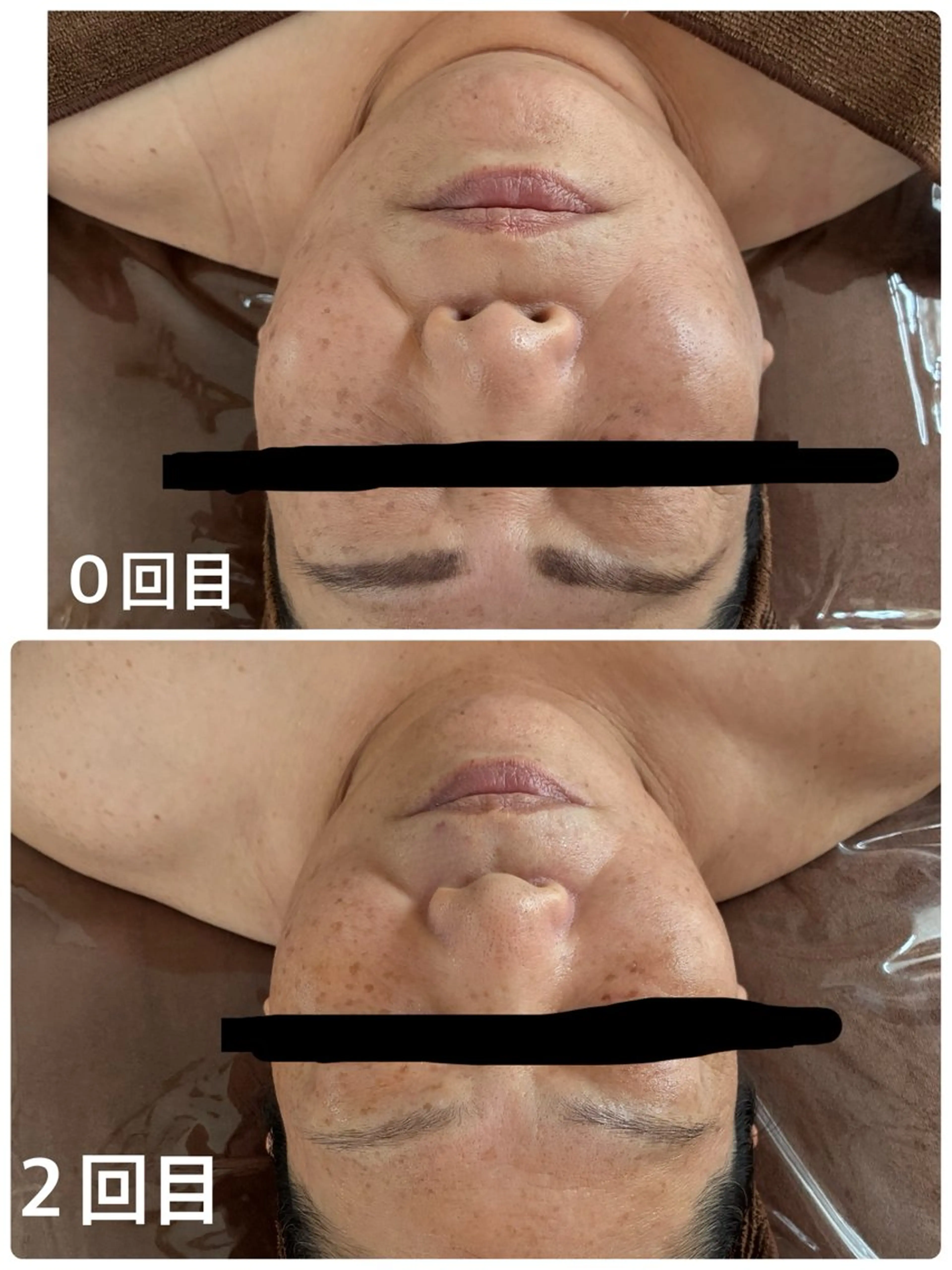 見た目劇的変化！光フェイシャルの写真