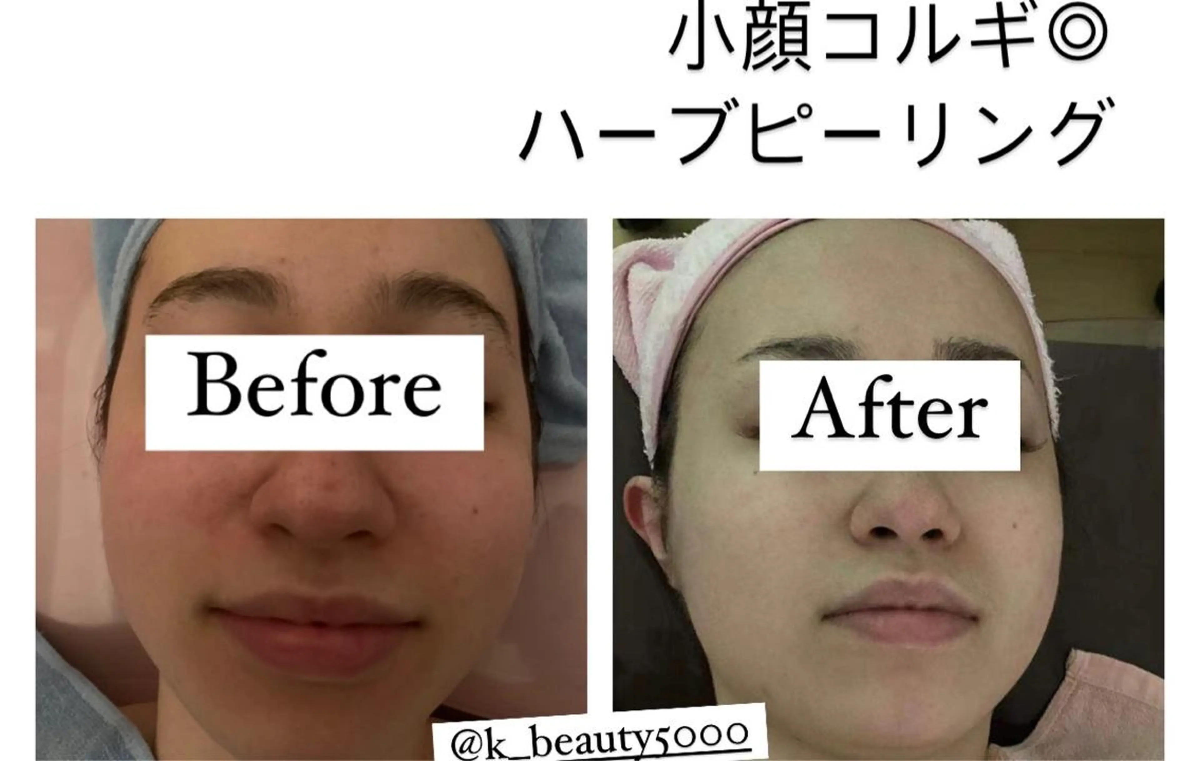 エステ 【ハイパーナイフ痩身&小顔コルギ&ハーブピーリング】K-Beauty　東新宿所属・kーbeauty小顔 コルギ&インディバのエステ・リラクイメージ