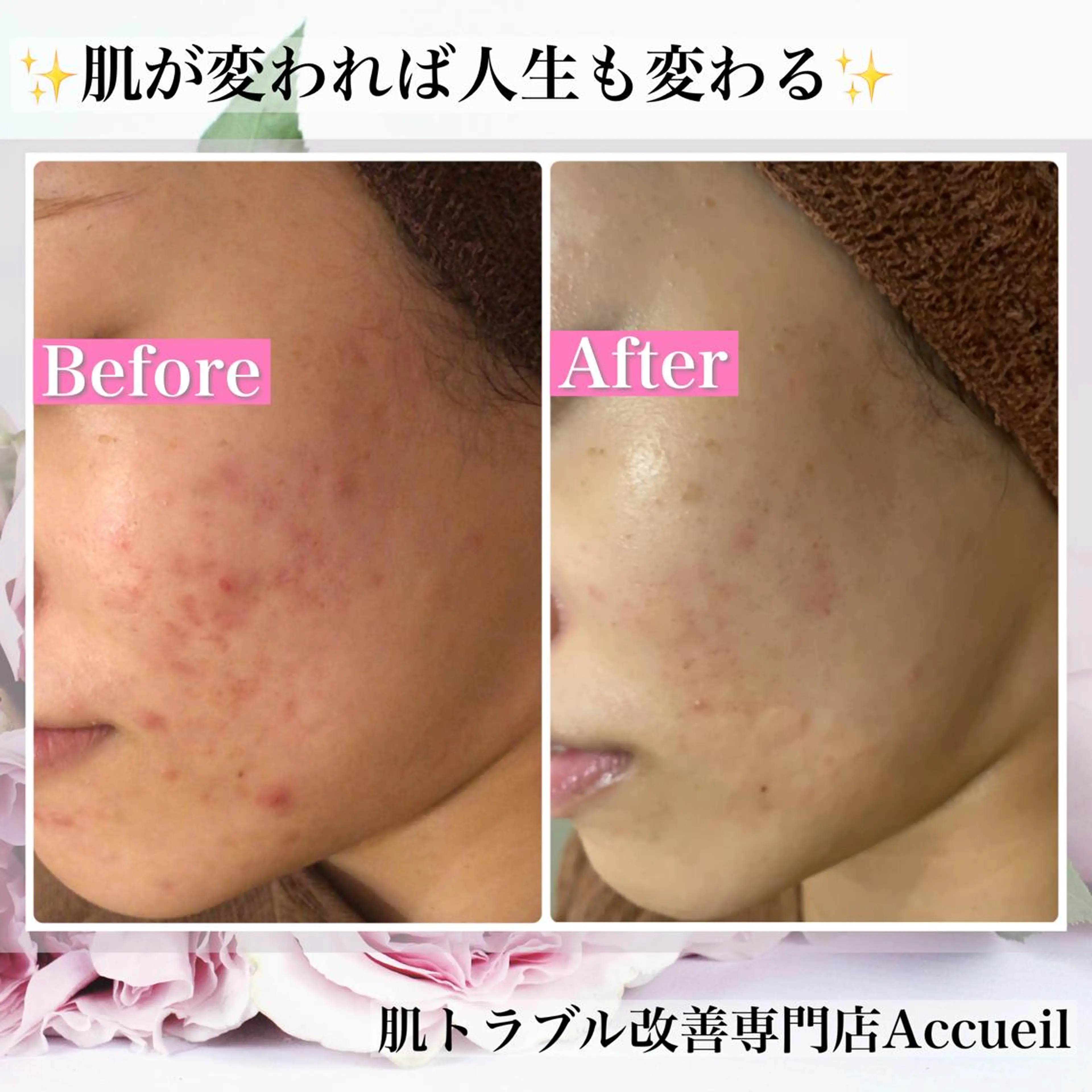 ミディアム カラー パーマ ヘアアレンジ メンズ キッズ ネイル マツエク・マツパ アイブロウ エステ リラク アクール　齋藤 ♡肌トラブル卒業のエステ・リラクイメージ