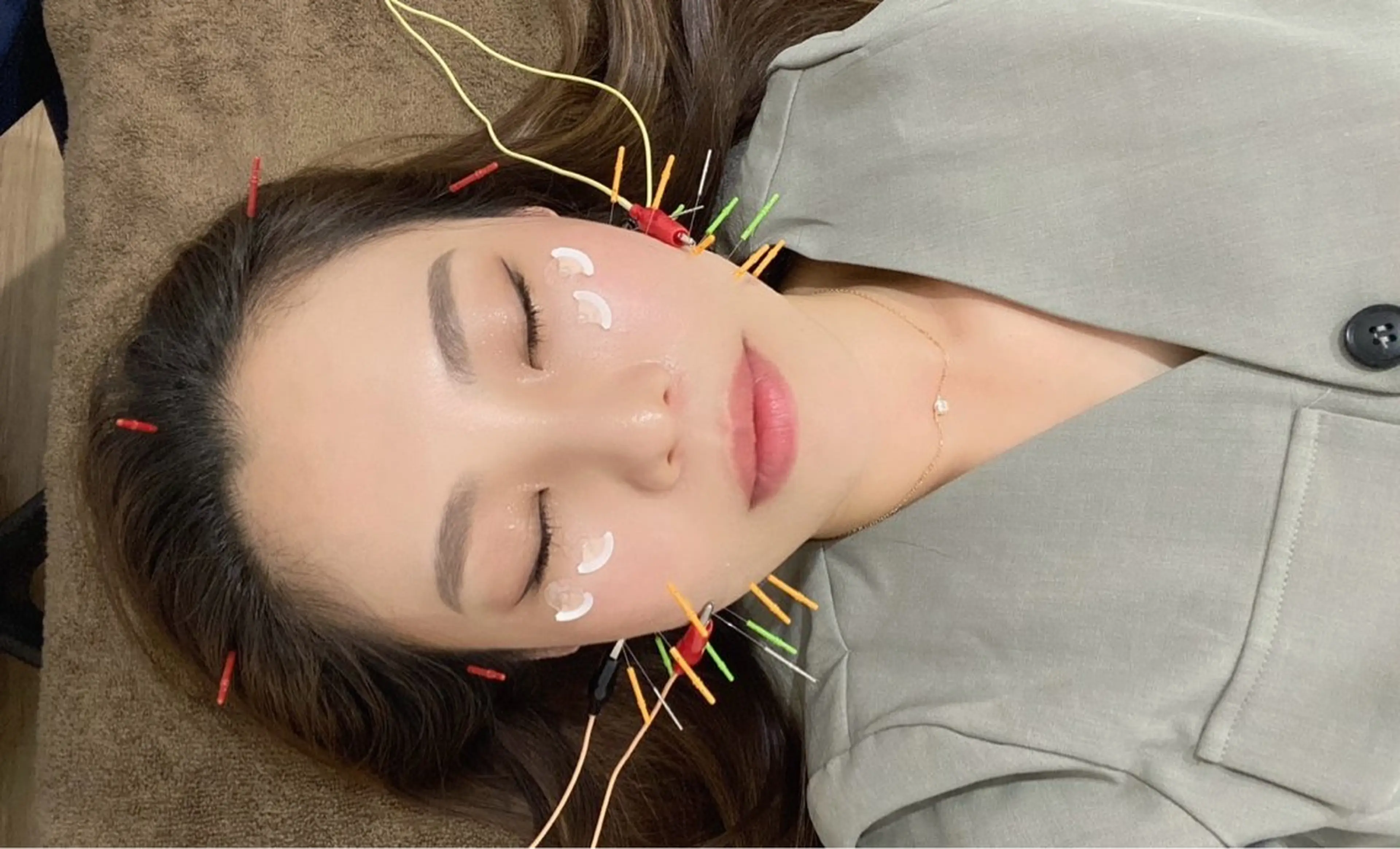 美容鍼の写真