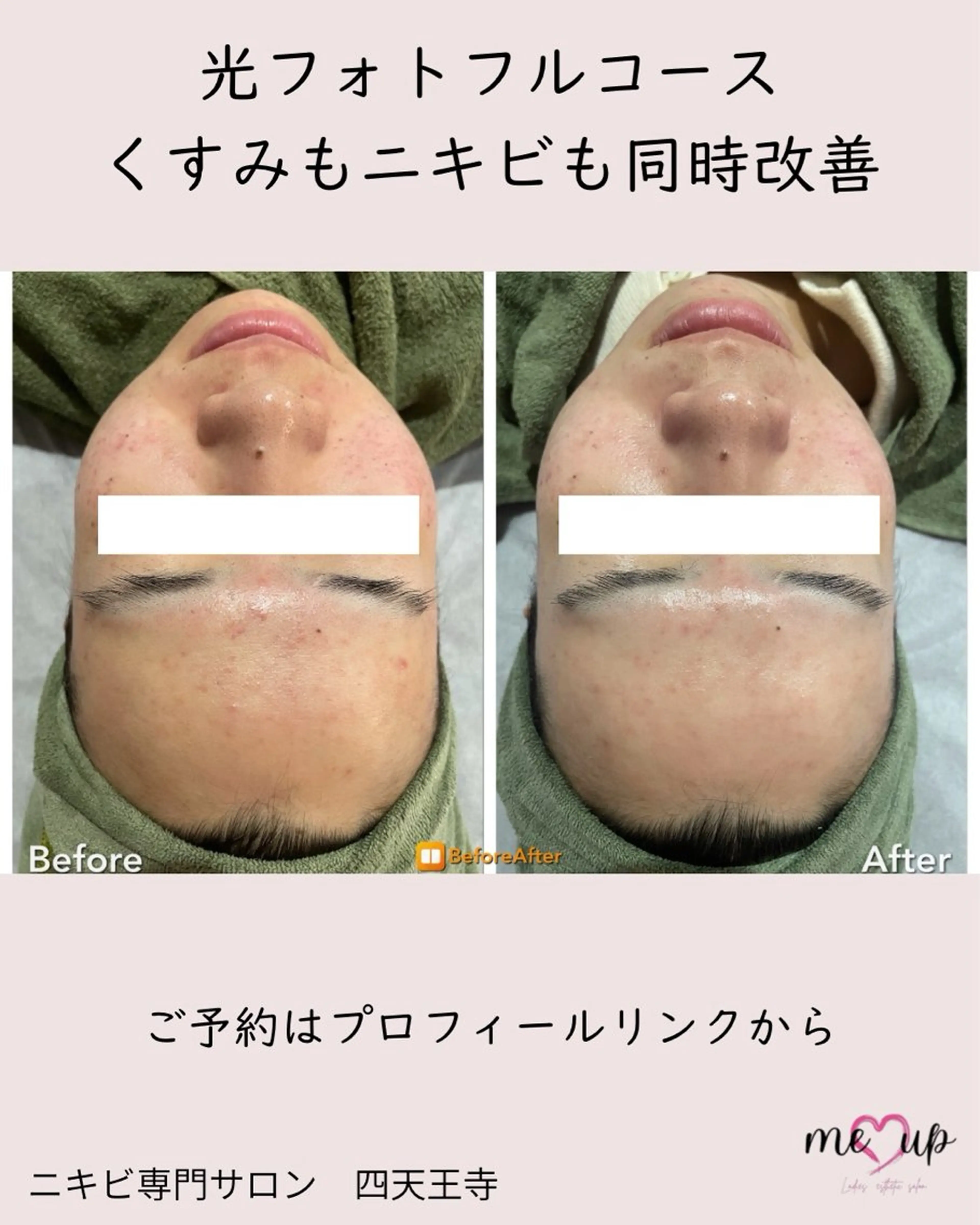 エステ Meupニキビ専門店 背中/ハーブ/ララのその他イメージ