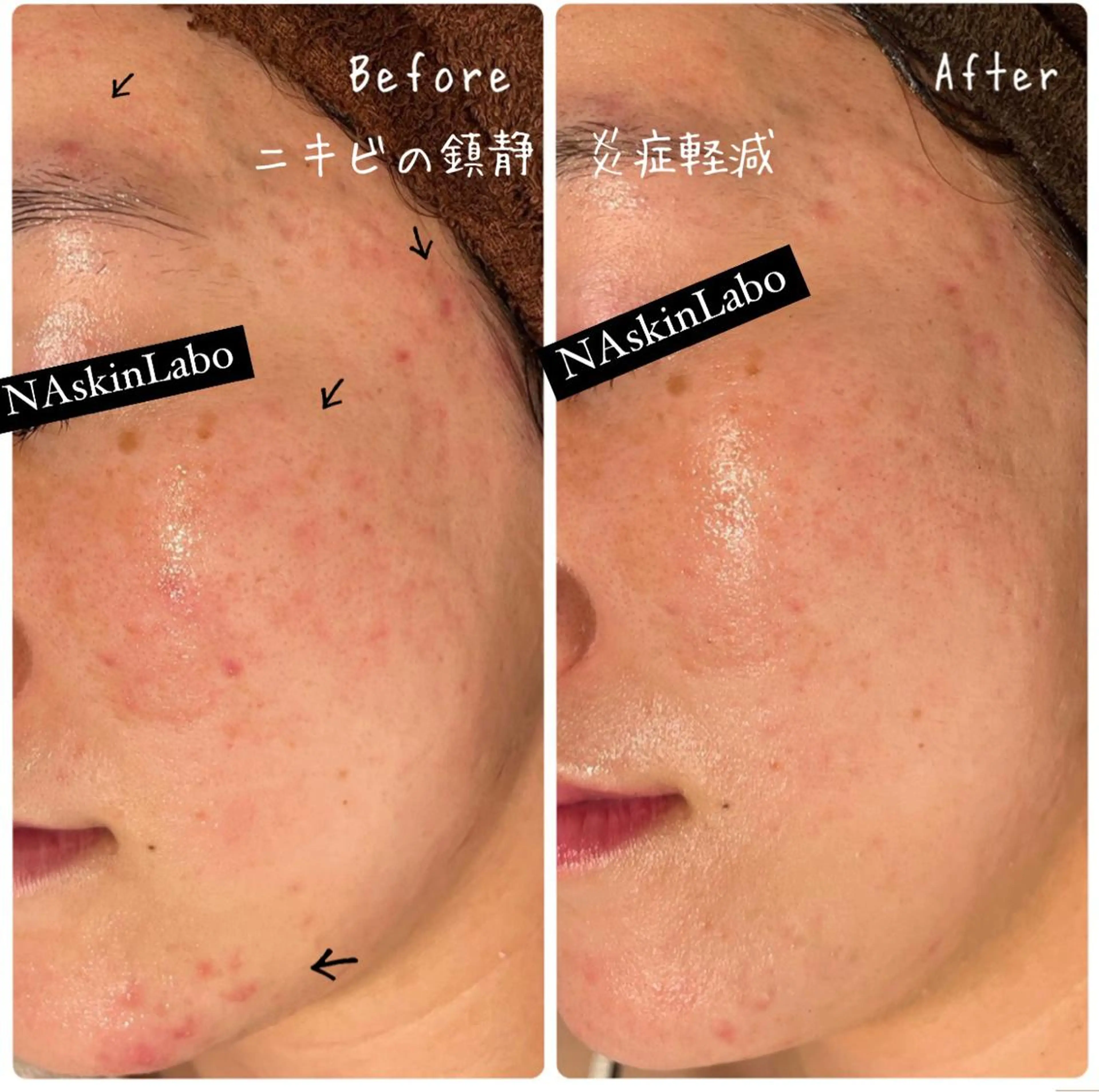 【ハーブピーリング/毛穴洗浄】NA skin 川崎店〜ニキビ・毛穴専門店〜所属・NAskin川崎 皆川のエステ・リラクイメージ