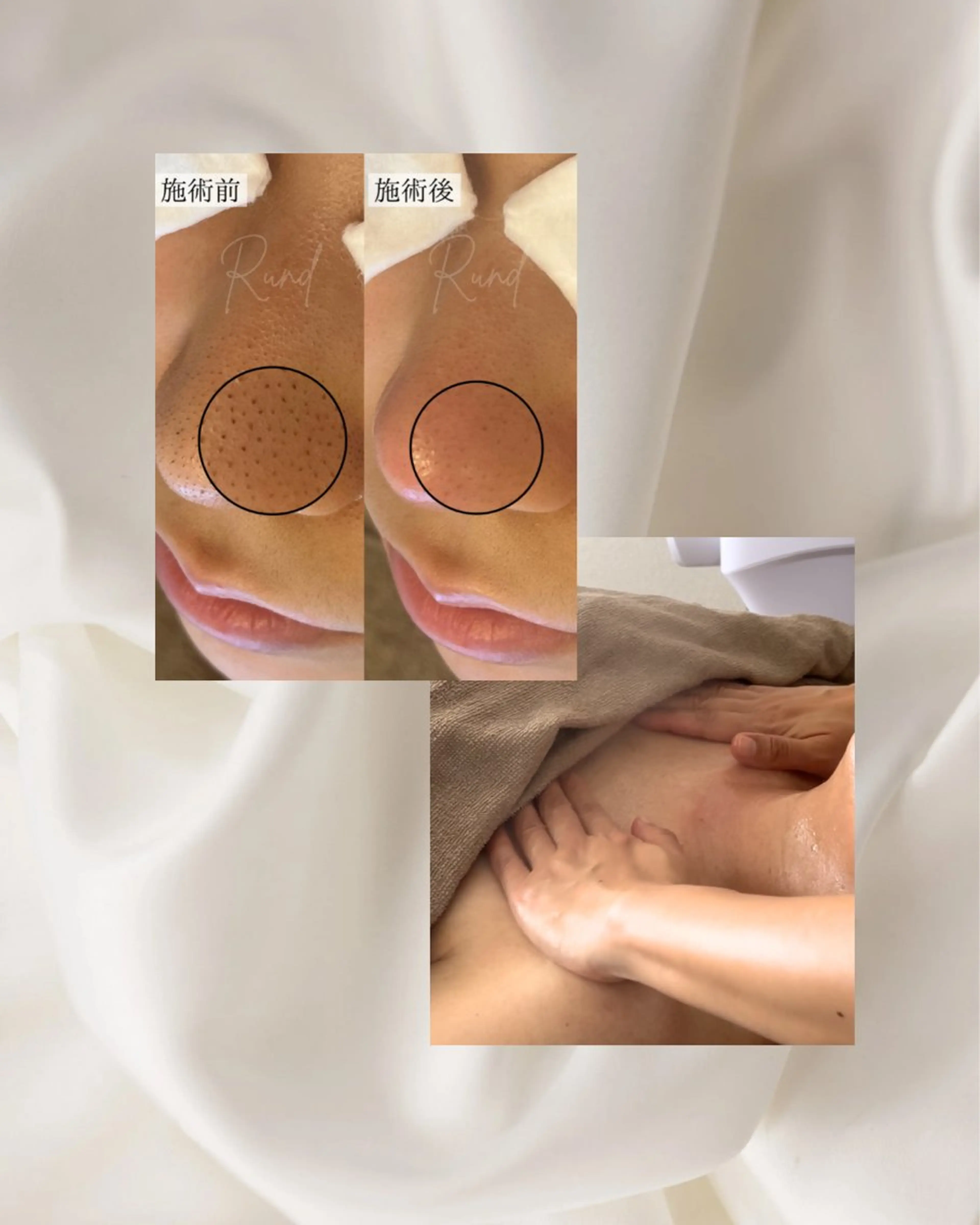 毛穴エクストラクションフェイシャル+デコルテマッサージの写真