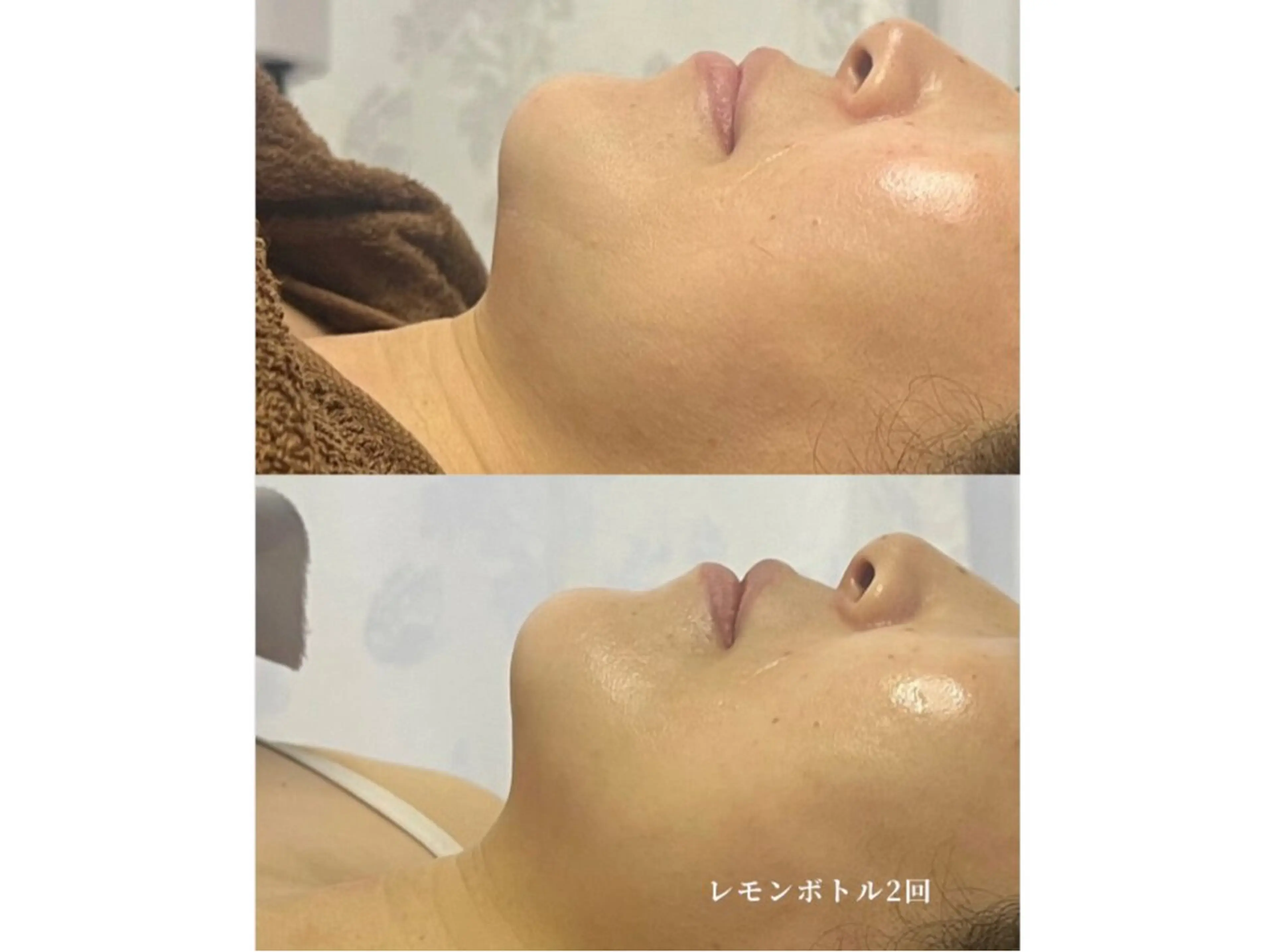 韓国で話題🇰🇷脂肪細胞集中アプローチでリフトアップ💖🤩【アクアダーマ✖️レモンボトル🍋】の写真