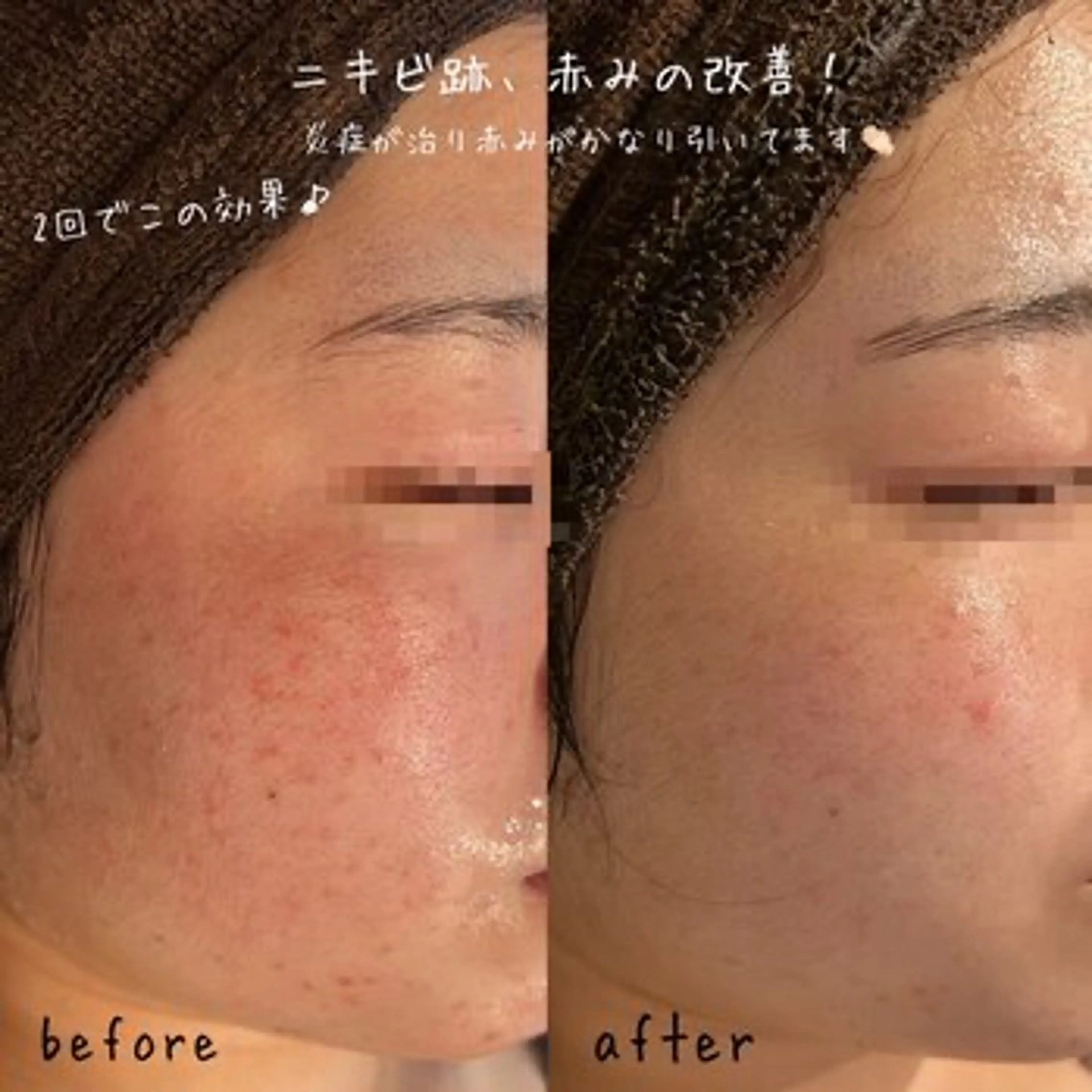 【ハーブピーリング/毛穴洗浄】NA skin 川崎店〜ニキビ・毛穴専門店〜所属・NAskin川崎 皆川のエステ・リラクイメージ
