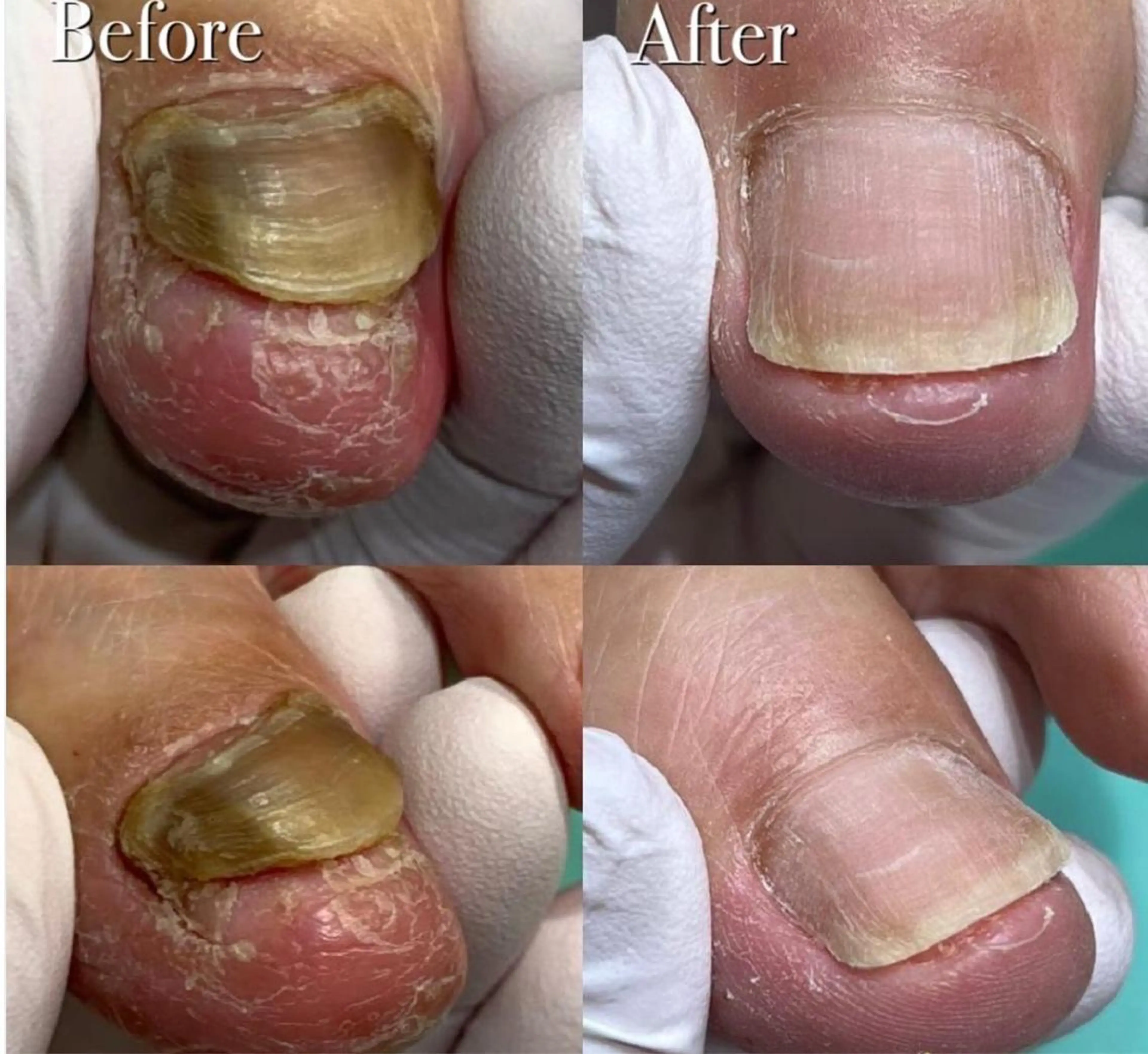 【分厚い爪・深爪補正】🉐🉐【再来4週間以内の限定】諦めないで下さい✨綺麗な爪を目指して補正いたします🌈の写真