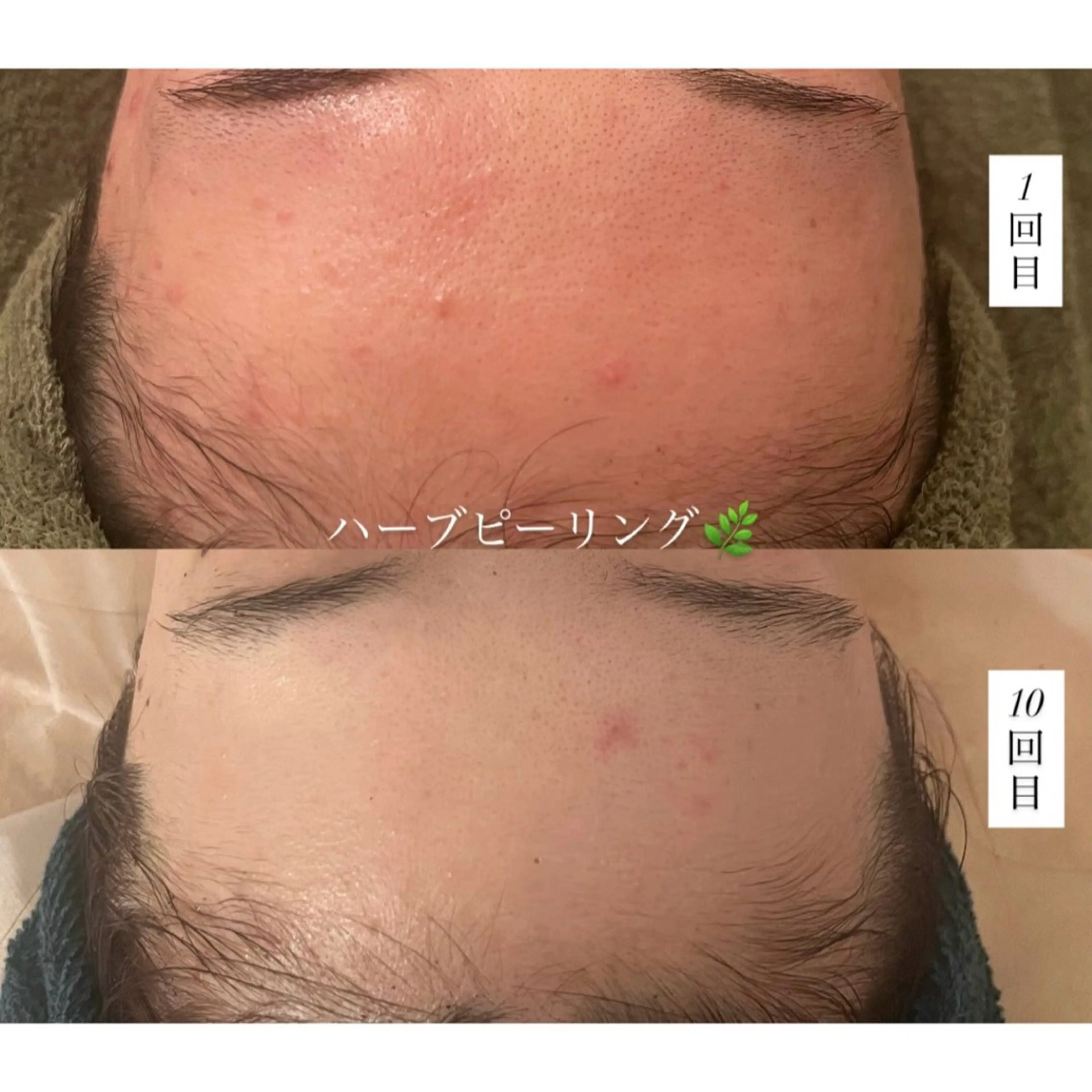 [結果重視✨] Reviハーブ2g➕オプション1種💎(デコルテ付)60分の写真