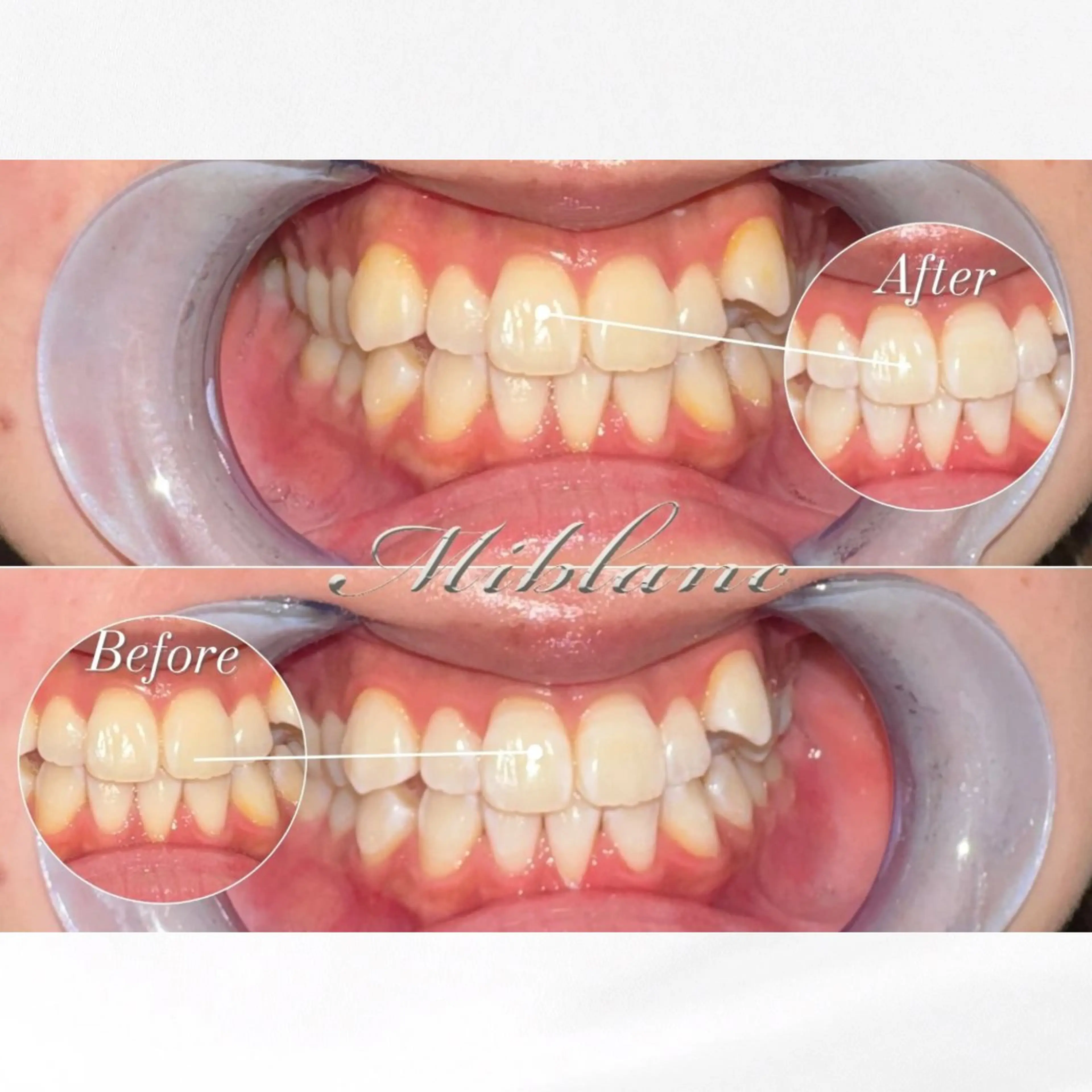 𝟕𝟓%off【モニター募集】🤎秋美容キャンペーン👩🏻‍🎓《ミニモ学割》Lightホワイトニング45分照射の写真