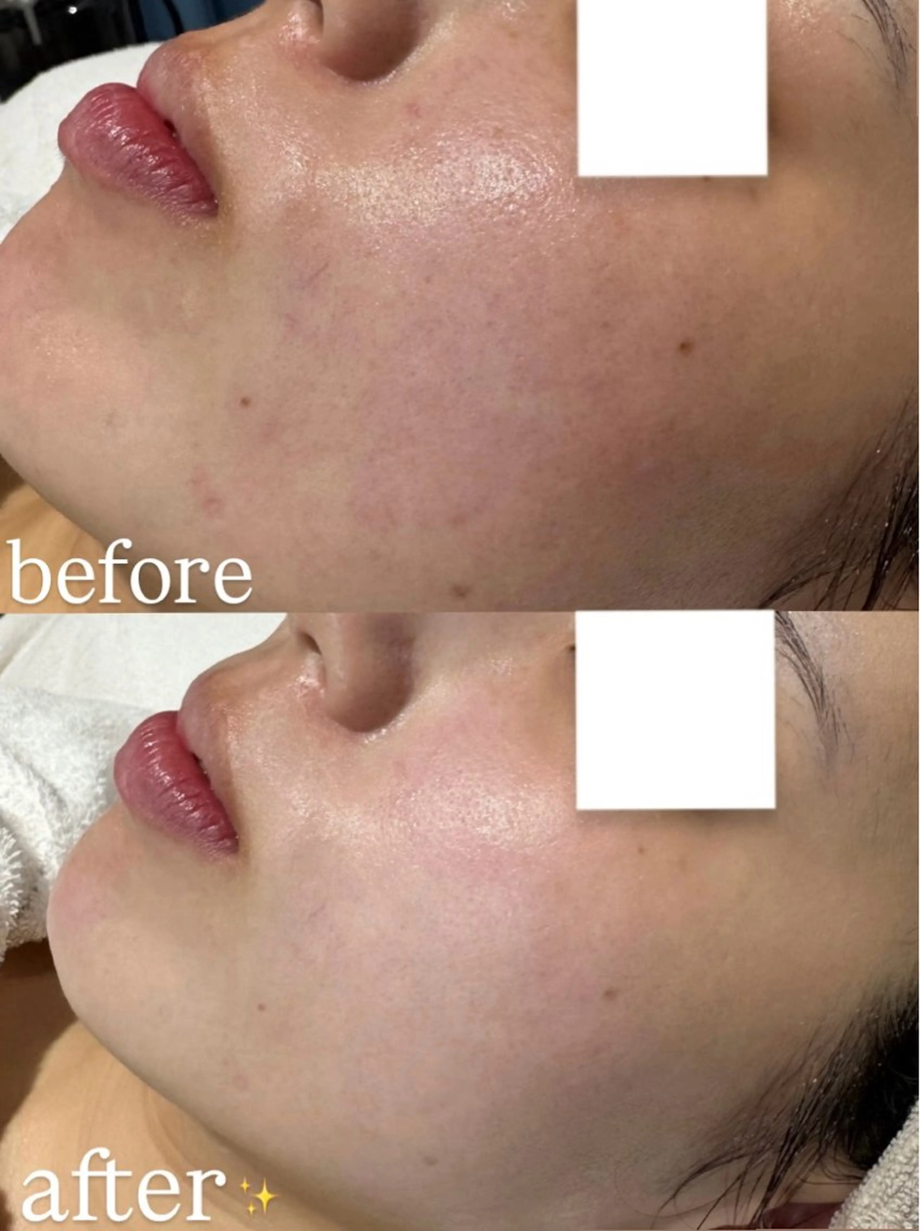 エステ 肌質改善/ mashikoのエステ・リラクイメージ