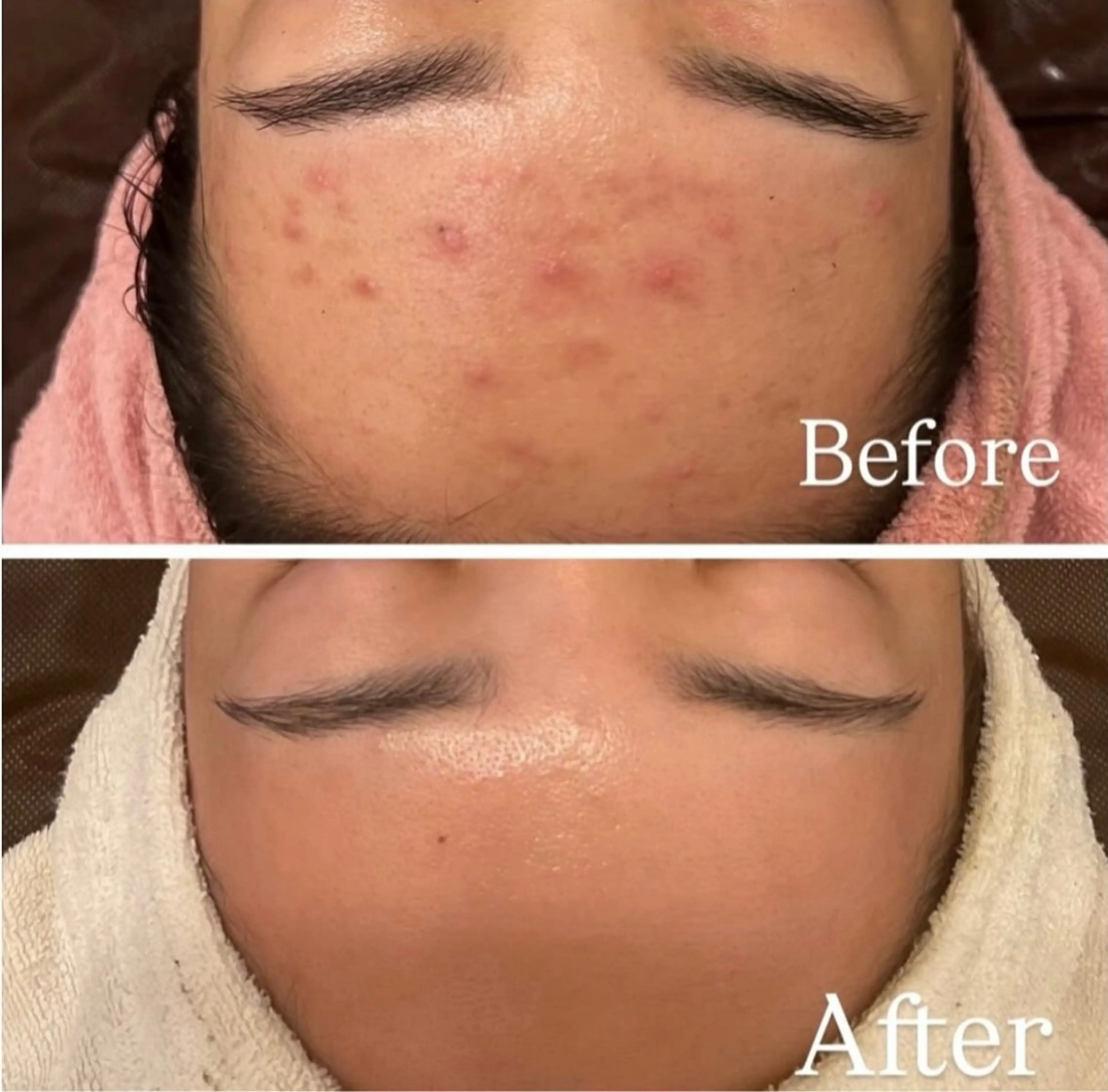 【ニキビケア】REVI剥離無しハーブピーリング+オプション4つ◎28600→10600の写真