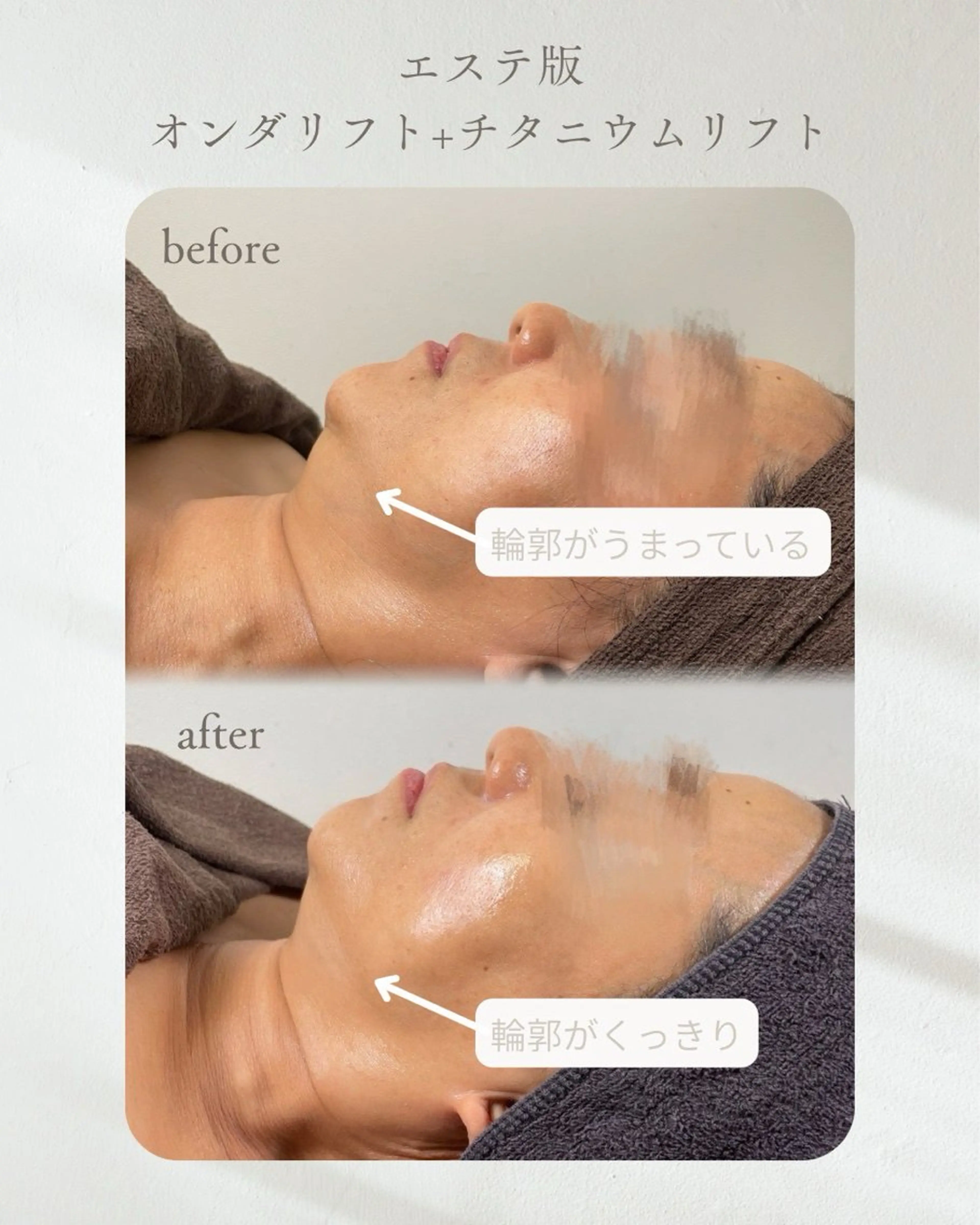 【モニター様募集❗️最新韓国美容ケア】エステ版オンダリフト¥6,000→¥3,000の写真