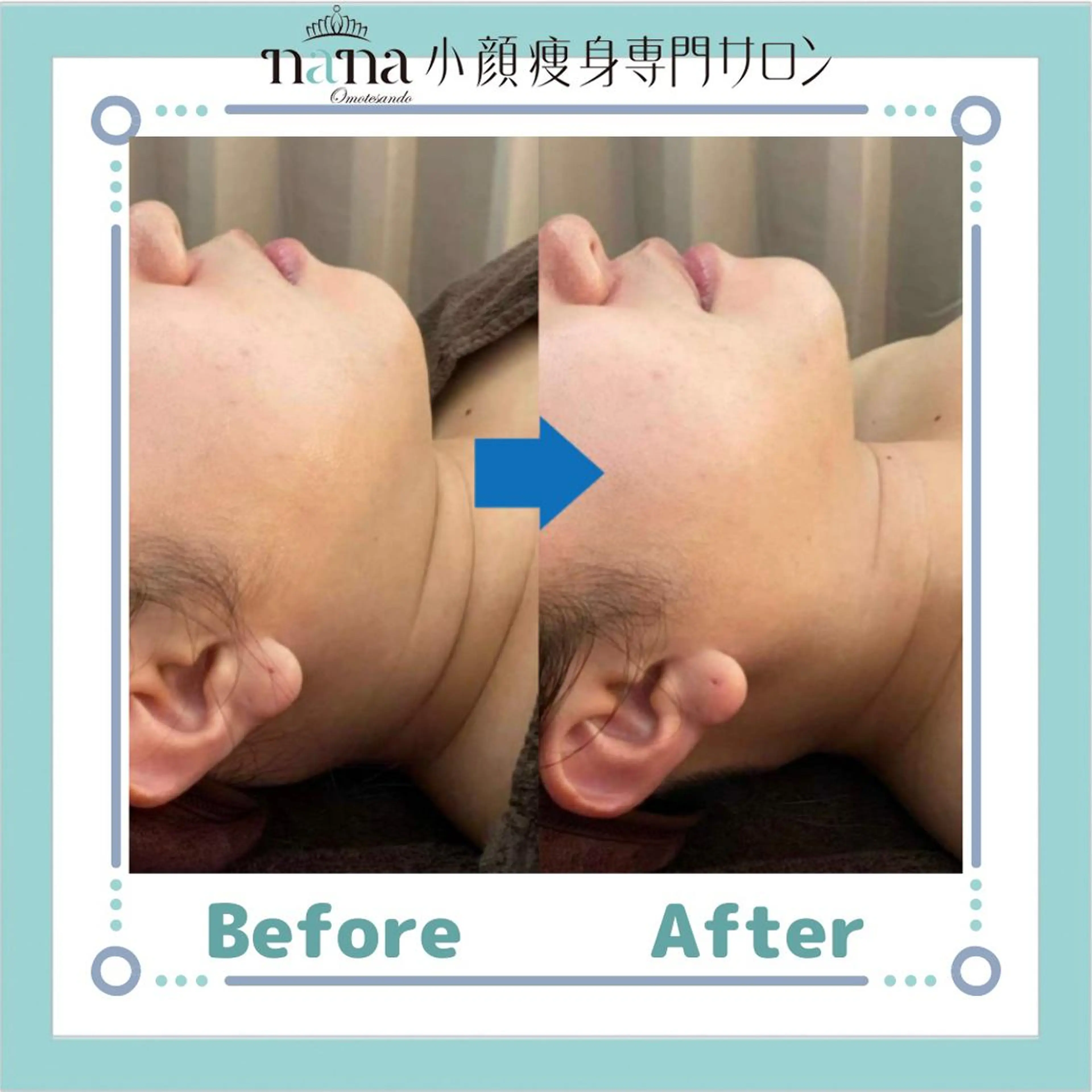 メンズ 小顔痩身インディバ Nana表参道のエステ・リラクイメージ