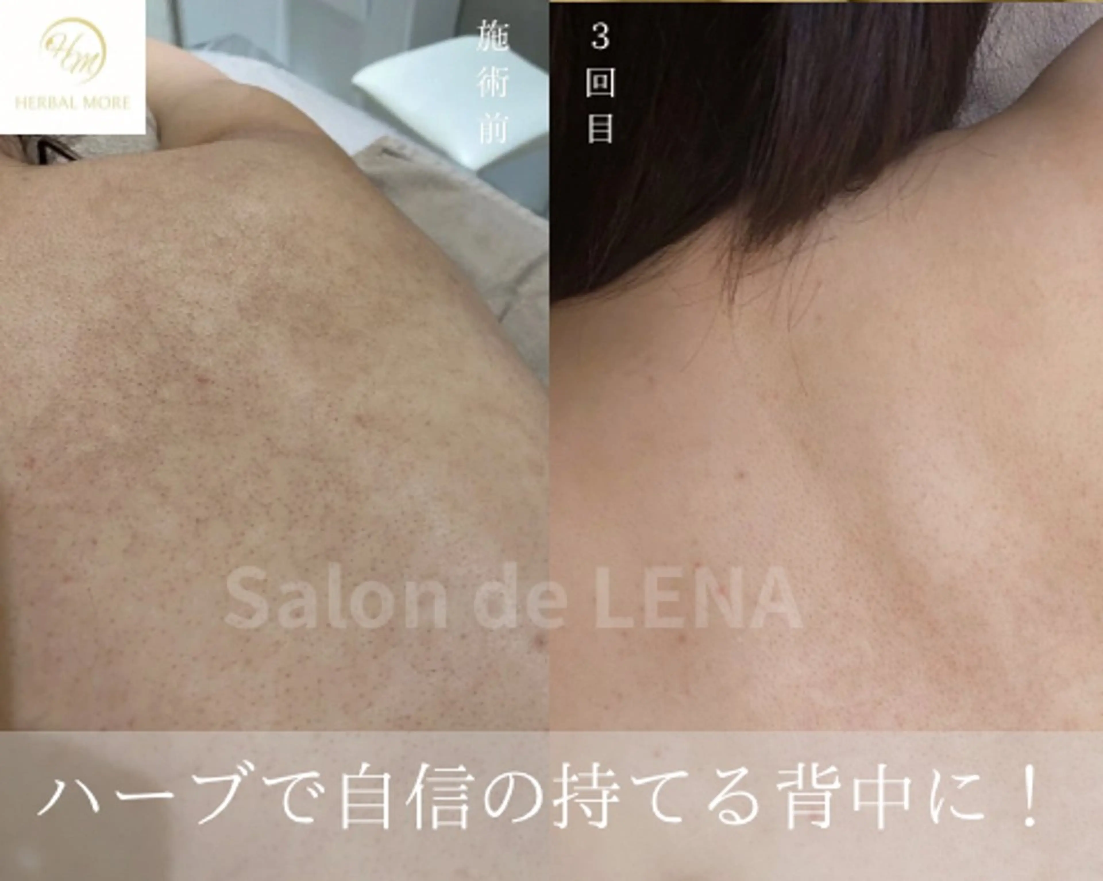 回数券購入経験がある方の都度払い/剥けないハーブピーリング顔or体から選択の写真