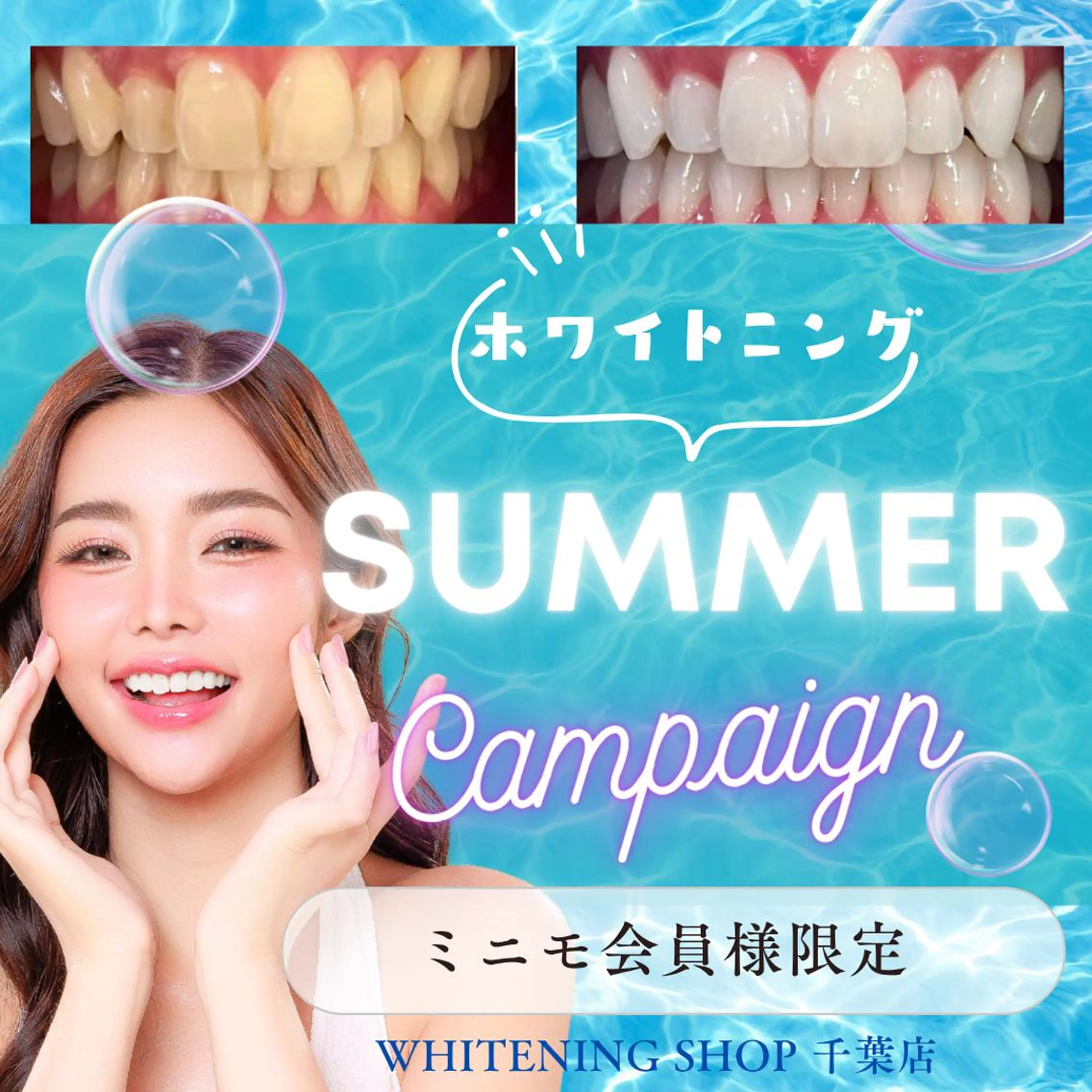 \8/15まで/【🏝️サマーキャンペーン☀️】Wホワイトニング💎¥5,980→¥1,980[15分×2回］の写真