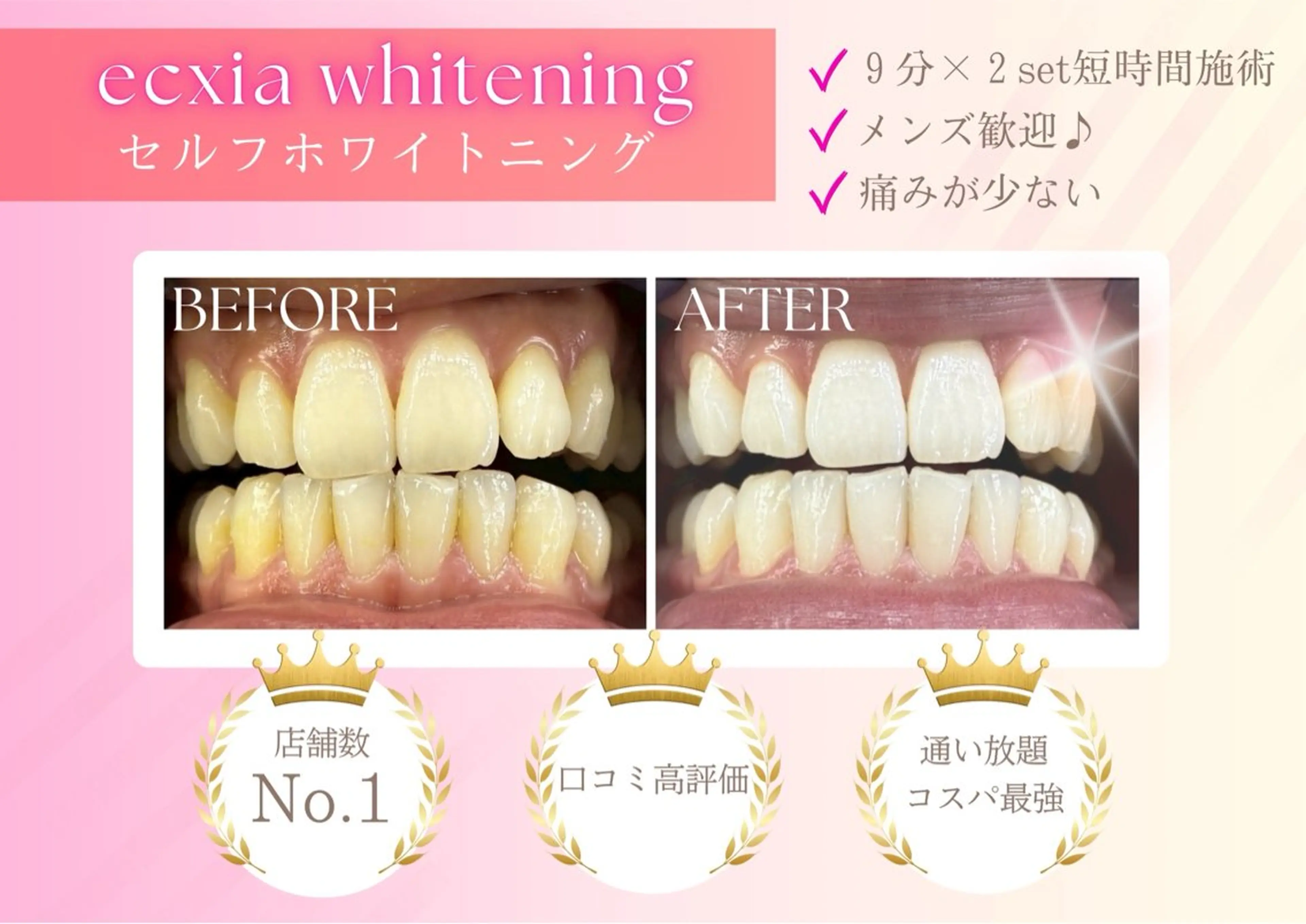 セルフホワイトニング(9分×2セット)¥3980→¥500の写真