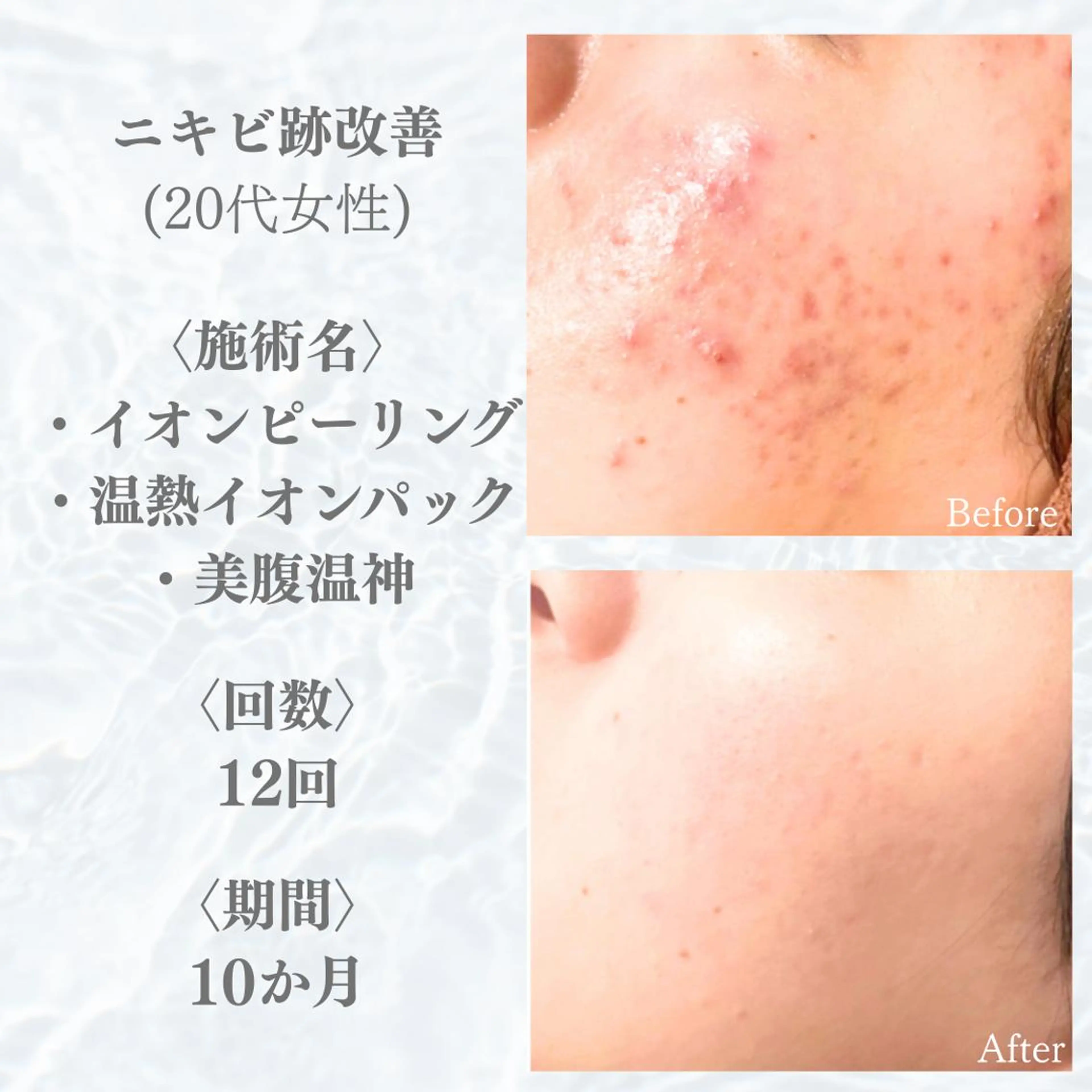 エステ リラク 実績6万人🔥 スピードニキビ改善のエステ・リラクイメージ