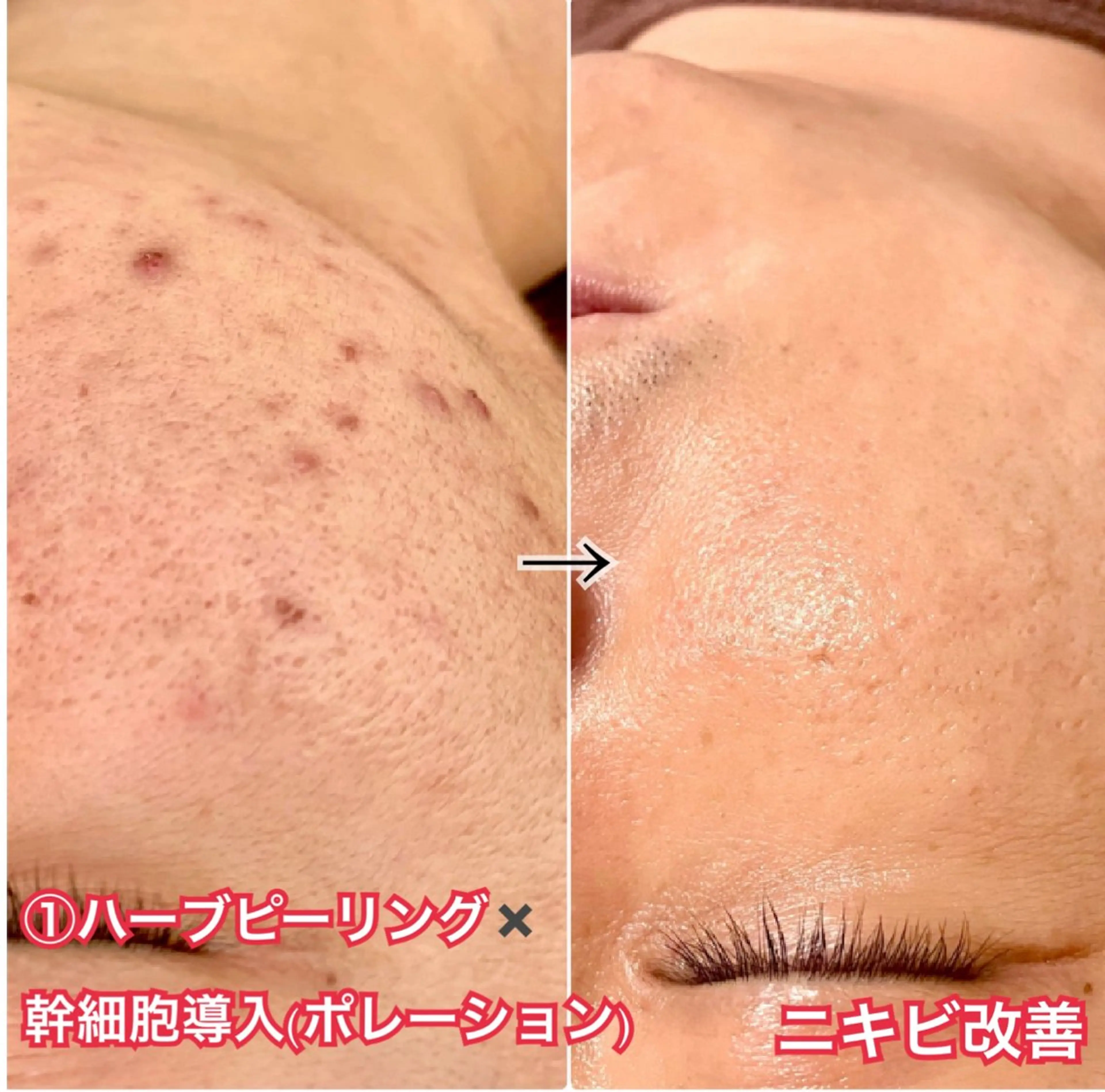 LAESSE 恵比寿所属・ラエッセ 恵比寿 ⭐︎yuuka⭐︎のエステ・リラクイメージ