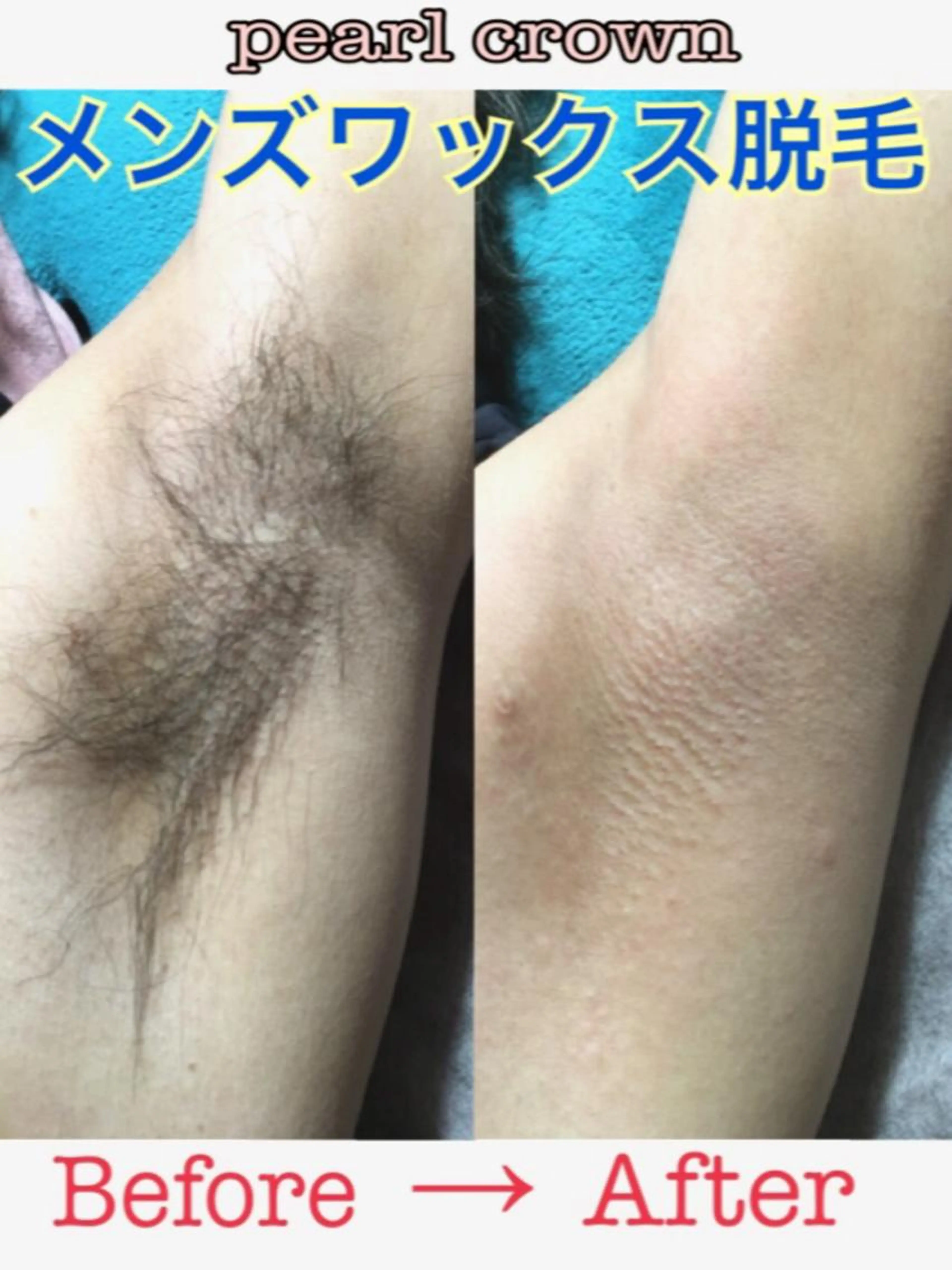 メンズ両わきワックス脱毛(ご新規・リピート可)の写真