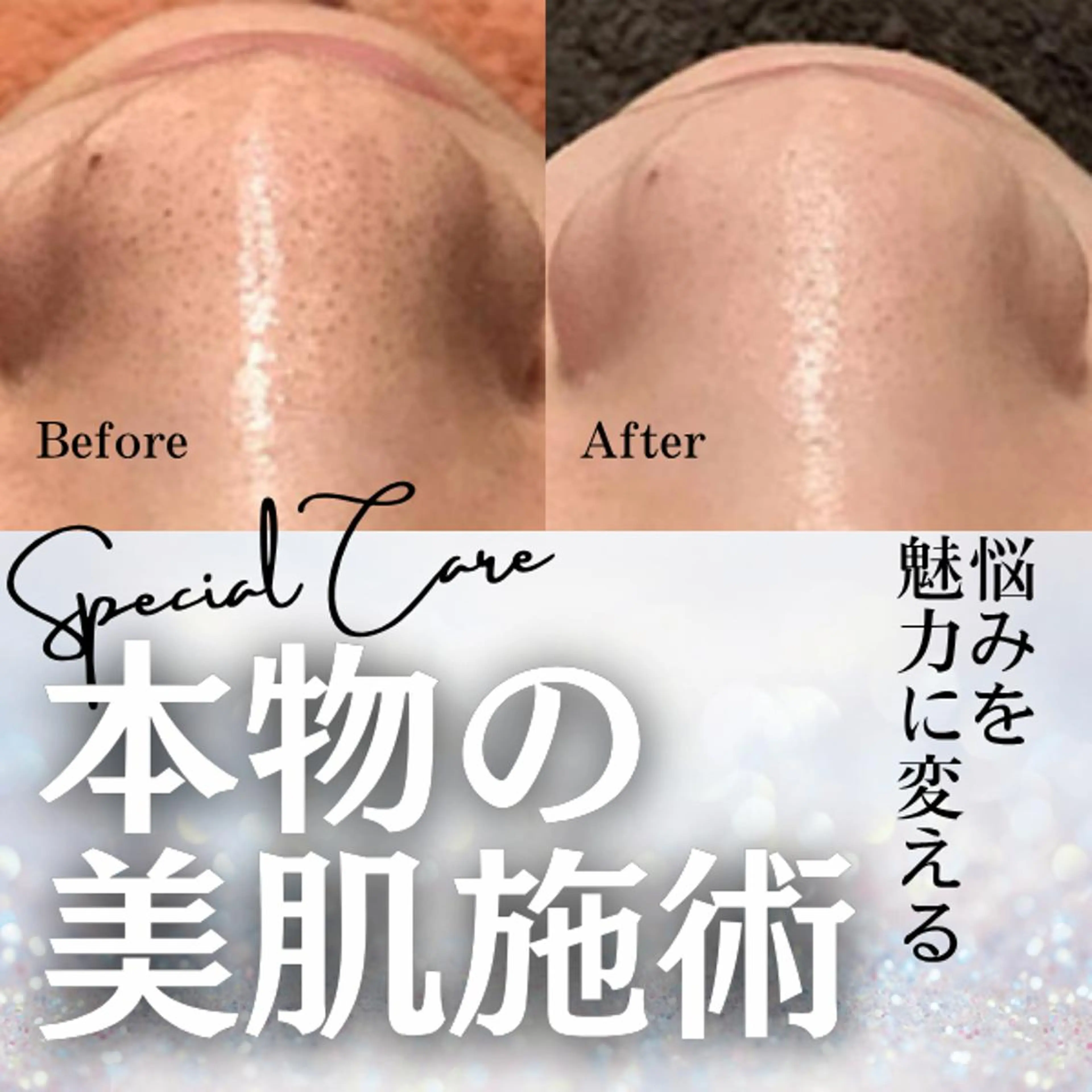 【20代に多い肌トラブルを改善】ニキビケア・毛穴黒ずみが気になる方にの写真