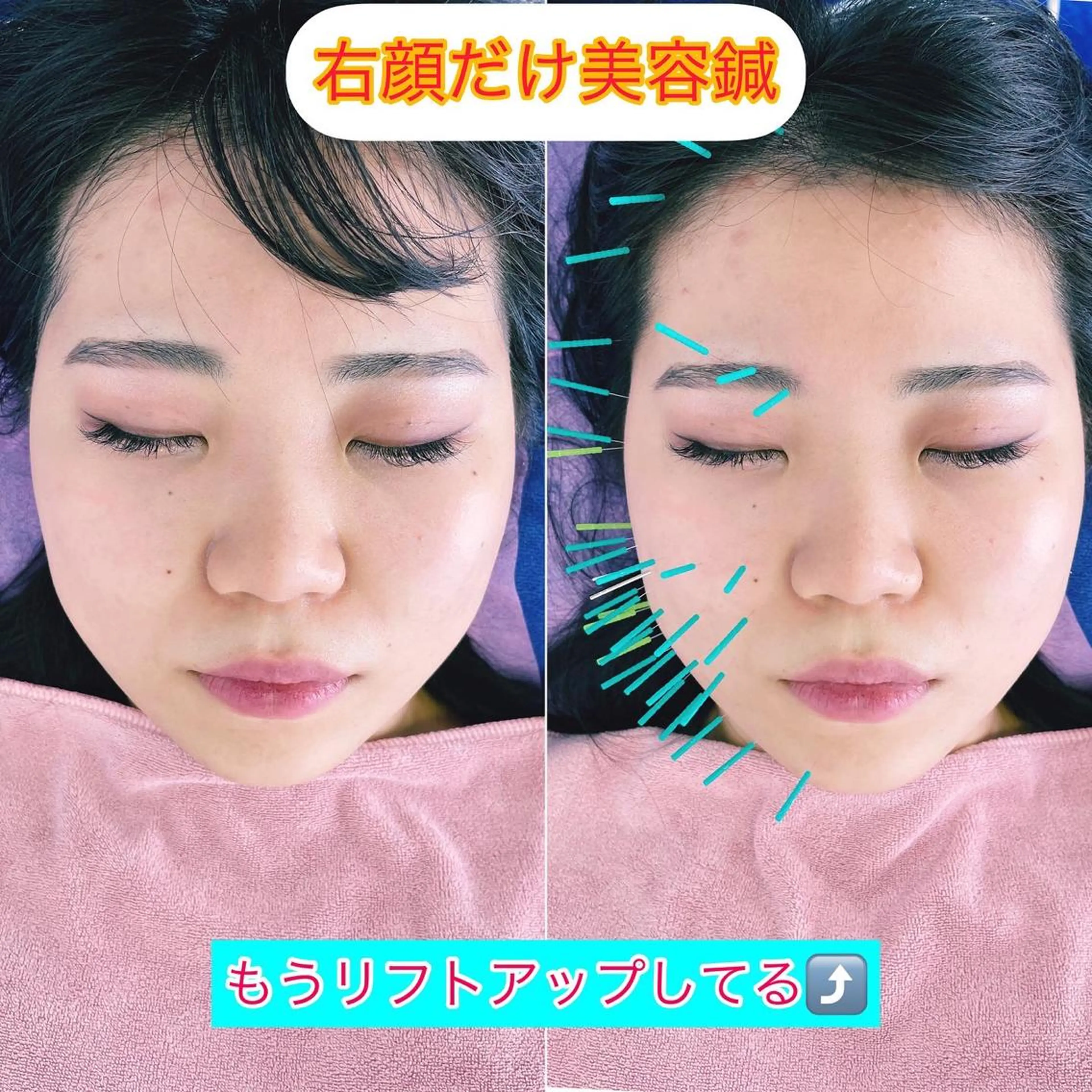 エステ リラク 小顔美容鍼専門サロン 渋谷YZのエステ・リラクイメージ