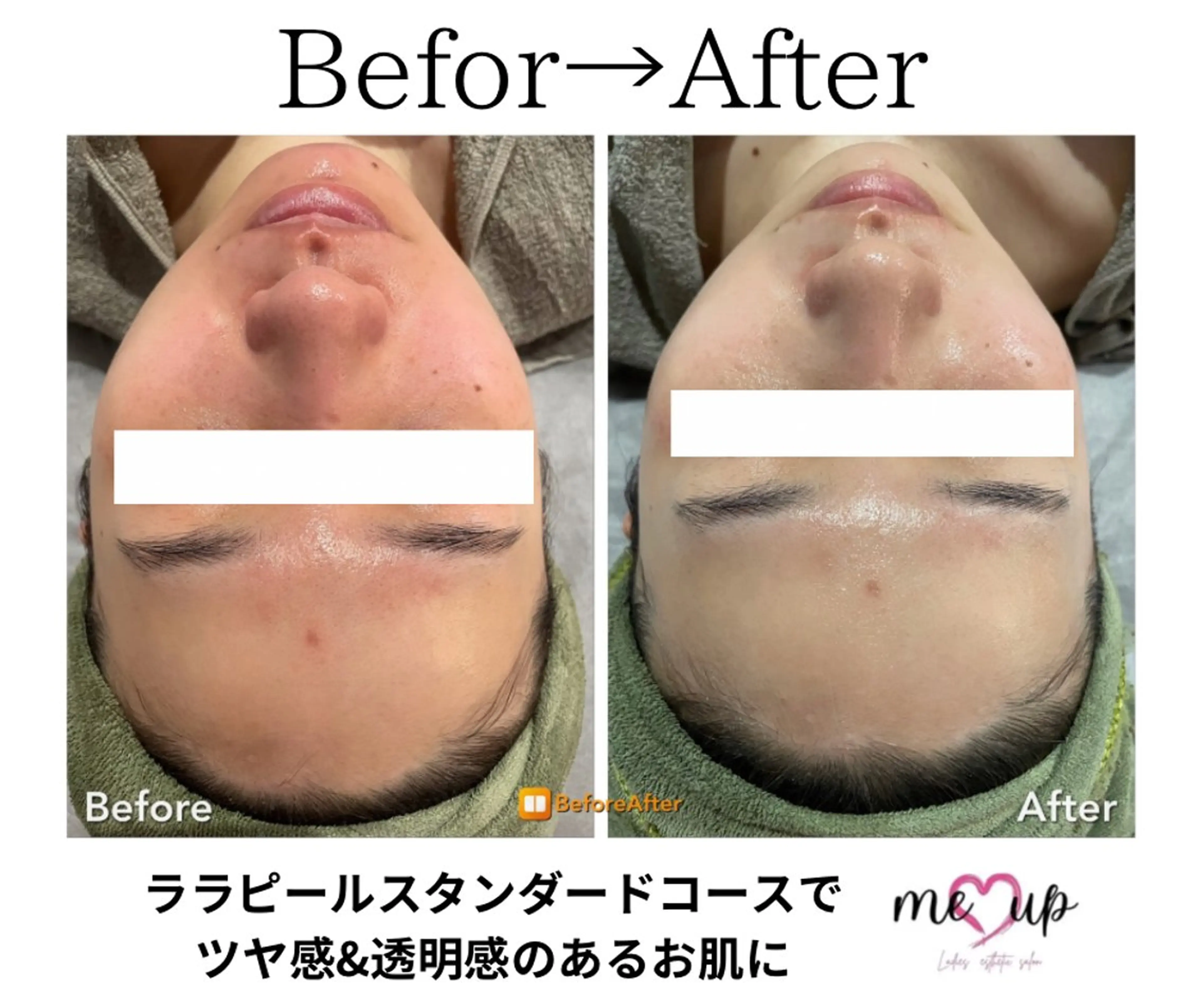 エステ Meupニキビ専門店 背中/ハーブ/ララのその他イメージ