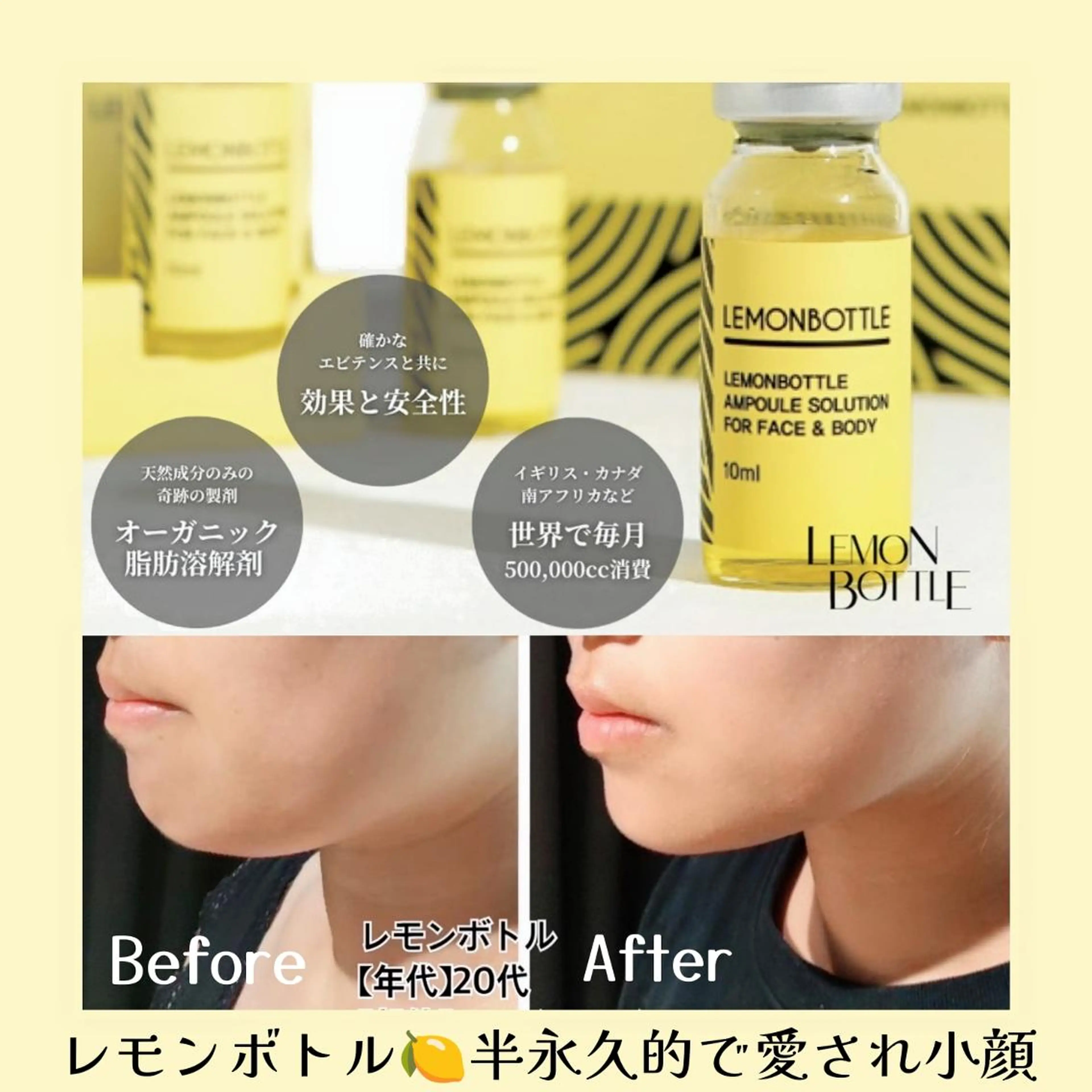 二重アゴ撃退【たるみケア★愛され小顔】レモン韓国ボトル2cc+EMS&デコルテマッサージ90分の写真