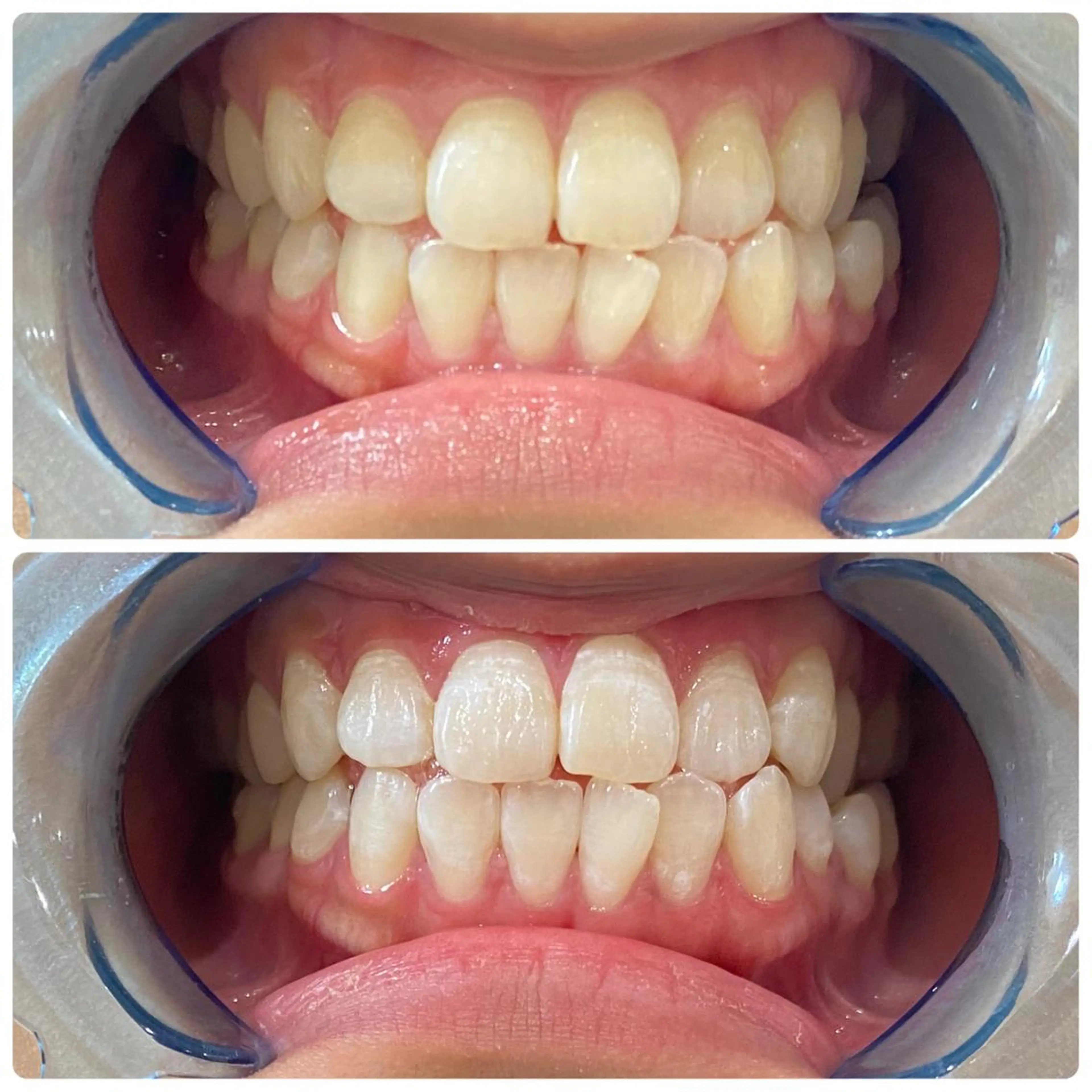 その他 White Berry SELF BEAUTY SALON所属・セルフホワイトニング 🦷口元垢抜け✨のその他イメージ