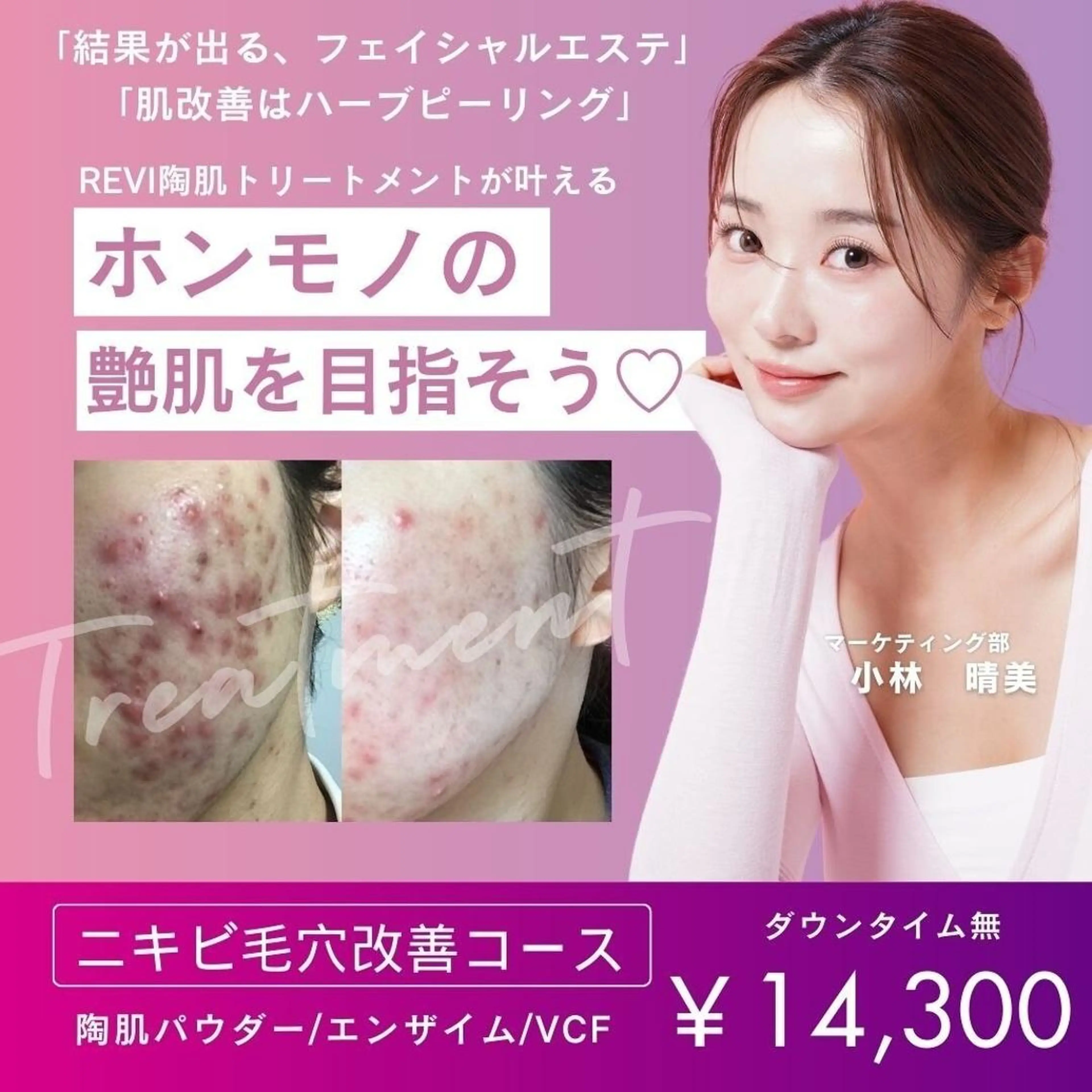 【繰り返すニキビ・跡に】ゆらぎ毛穴×赤み鎮静×化粧崩れ×透明感UPケアの写真