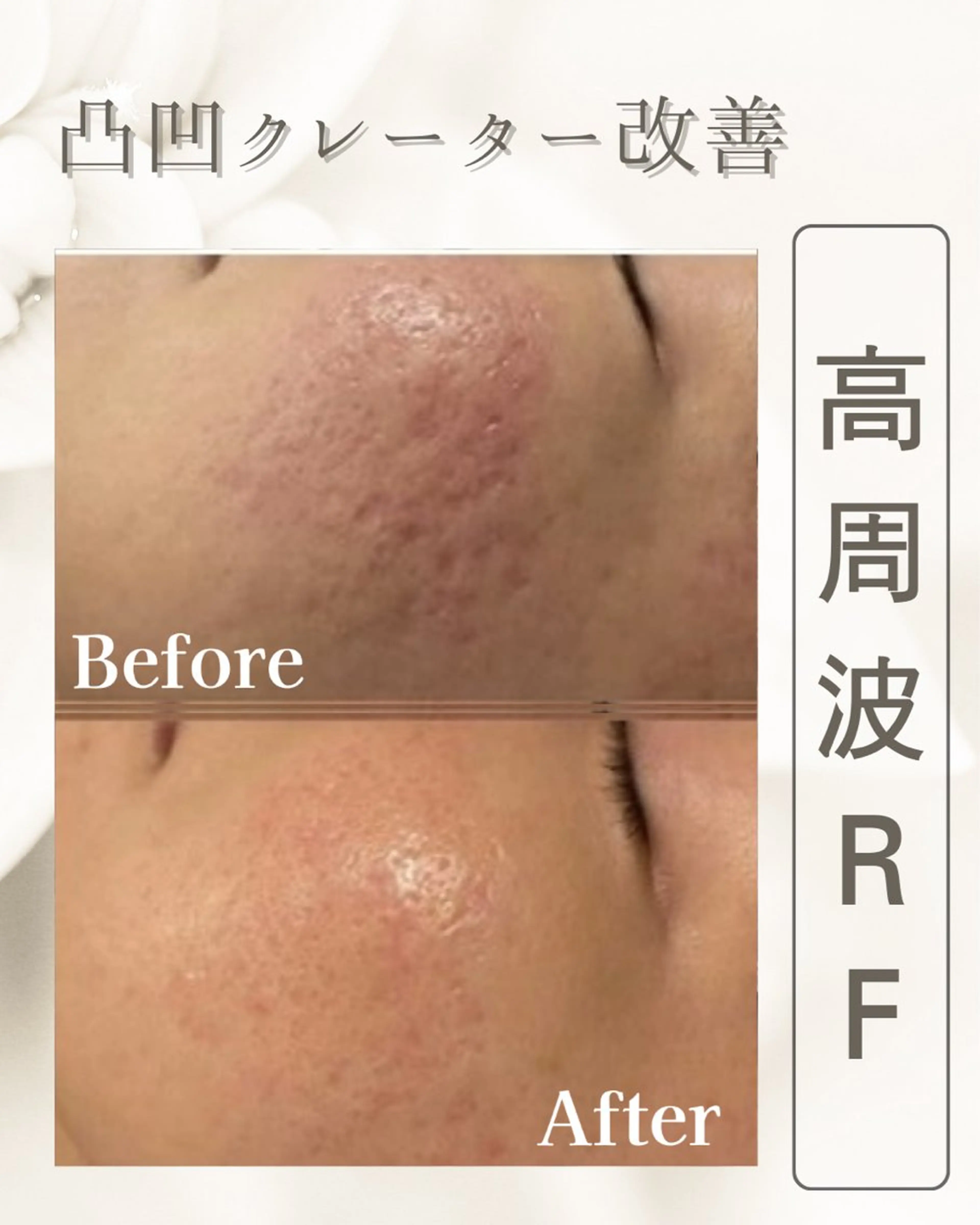 小顔／毛穴開き/肌の凸凹が気になる方へ【芸能人愛用】サーマトリックス選べる3箇所パック付の写真