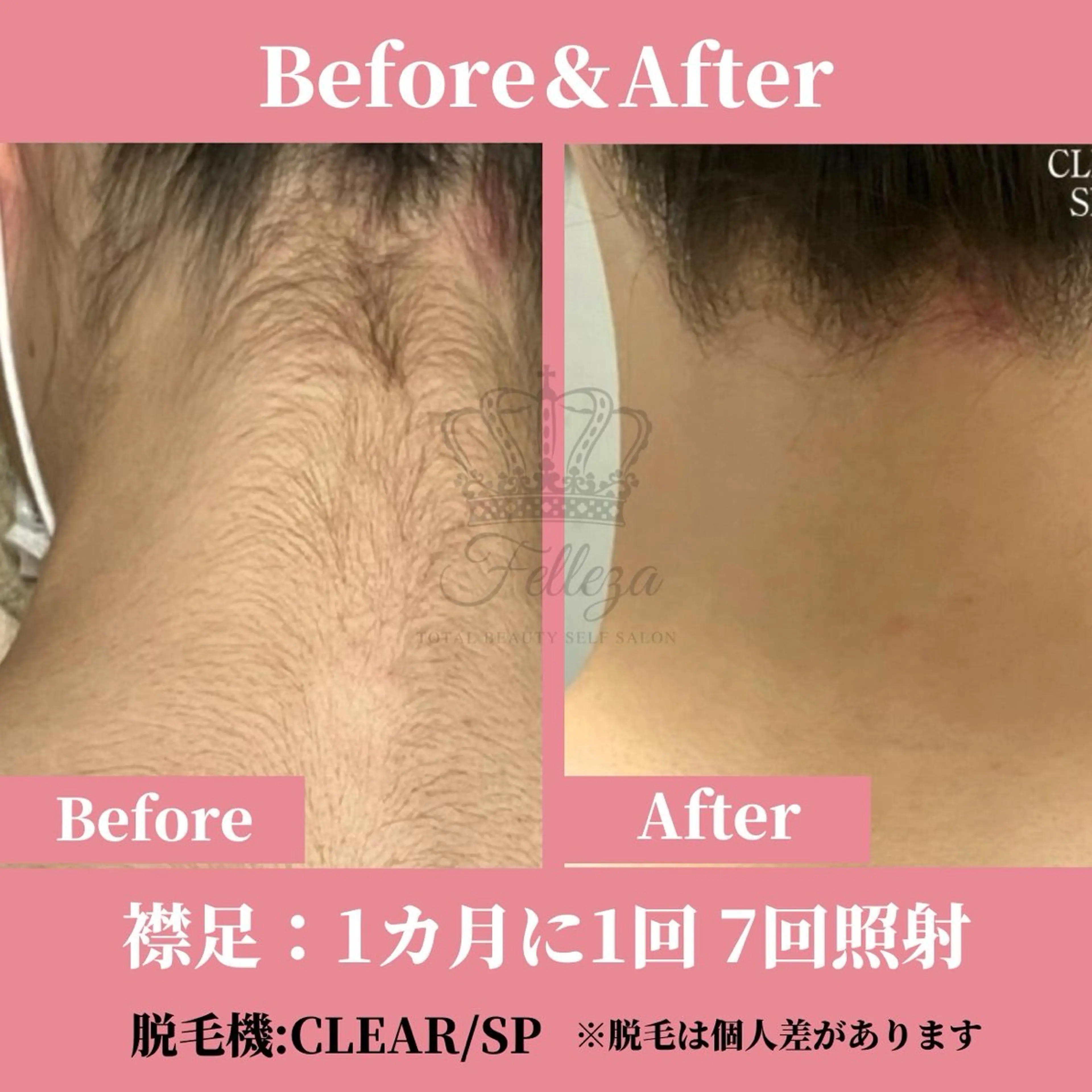 メンズ キッズ 脱毛 有人型セルフサロン 脱毛/痩身/美顔のその他イメージ